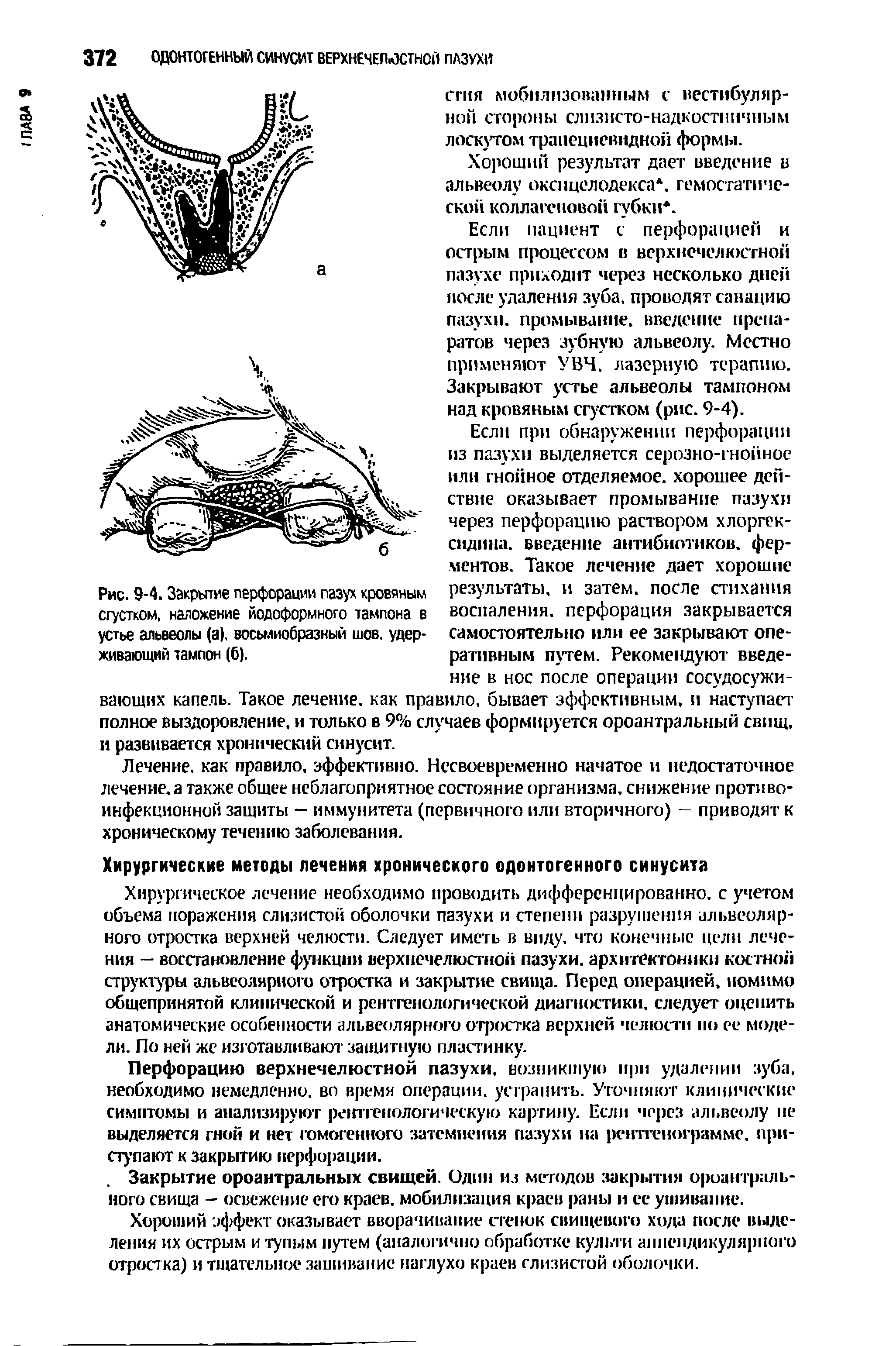 Рис. 9-4. Закрытие перфорации пазух кровяным сгустком, наложение йодоформного тампона в устье альвеолы (а), восьмиобразный шов. удерживающий тампон (б).