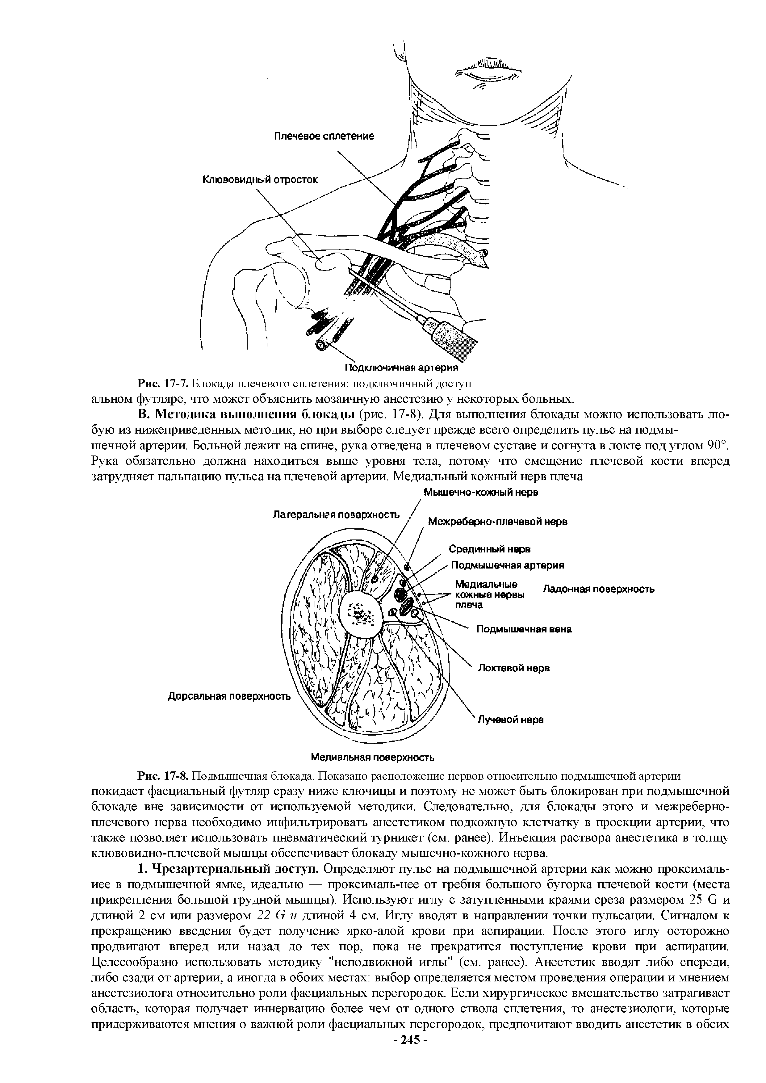 Рис. 17-7. Блокада плечевого сплетения подключичный доступ альном футляре, что может объяснить мозаичную анестезию у некоторых больных.
