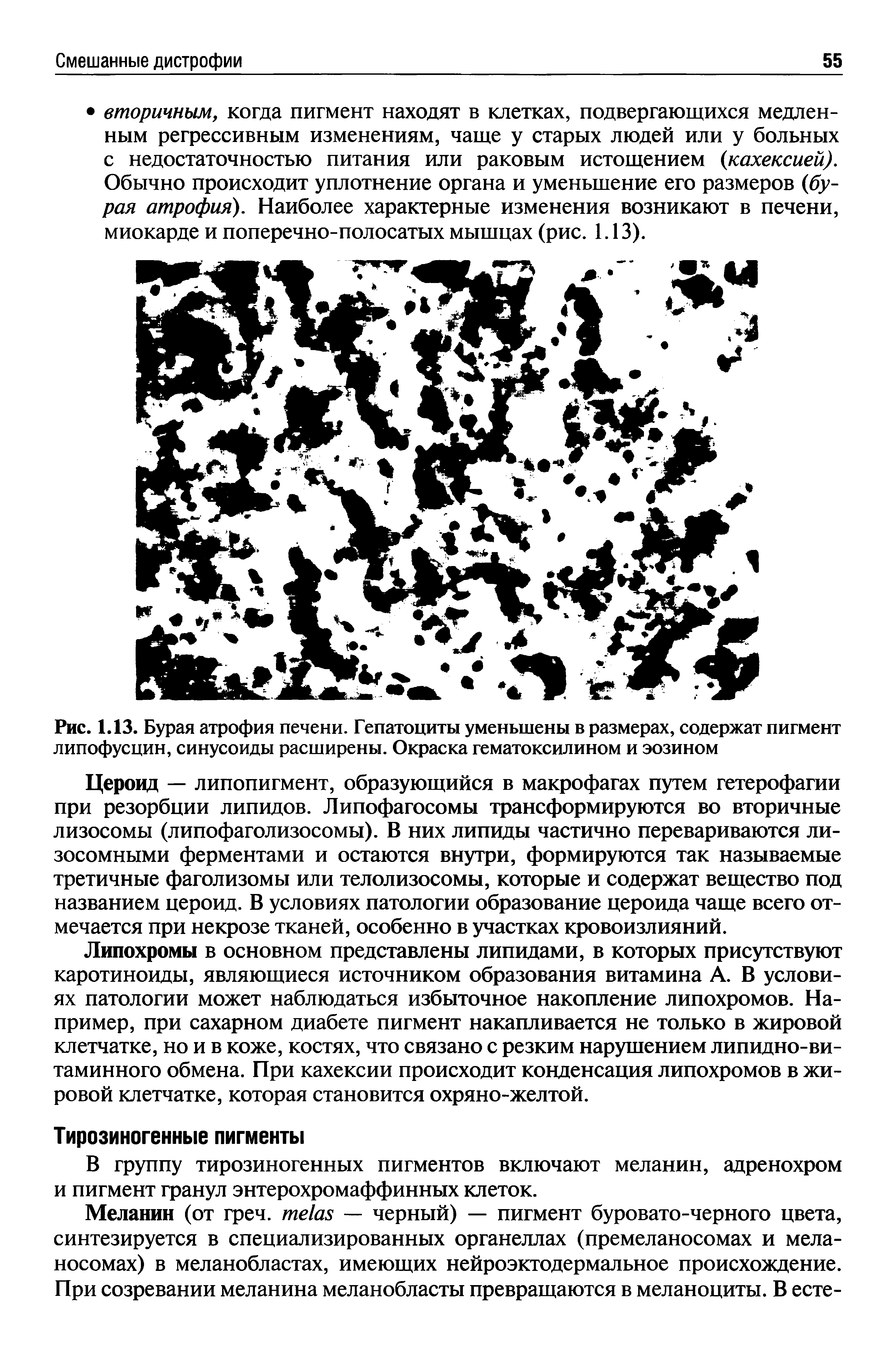 Рис. 1.13. Бурая атрофия печени. Гепатоциты уменьшены в размерах, содержат пигмент липофусцин, синусоиды расширены. Окраска гематоксилином и эозином...