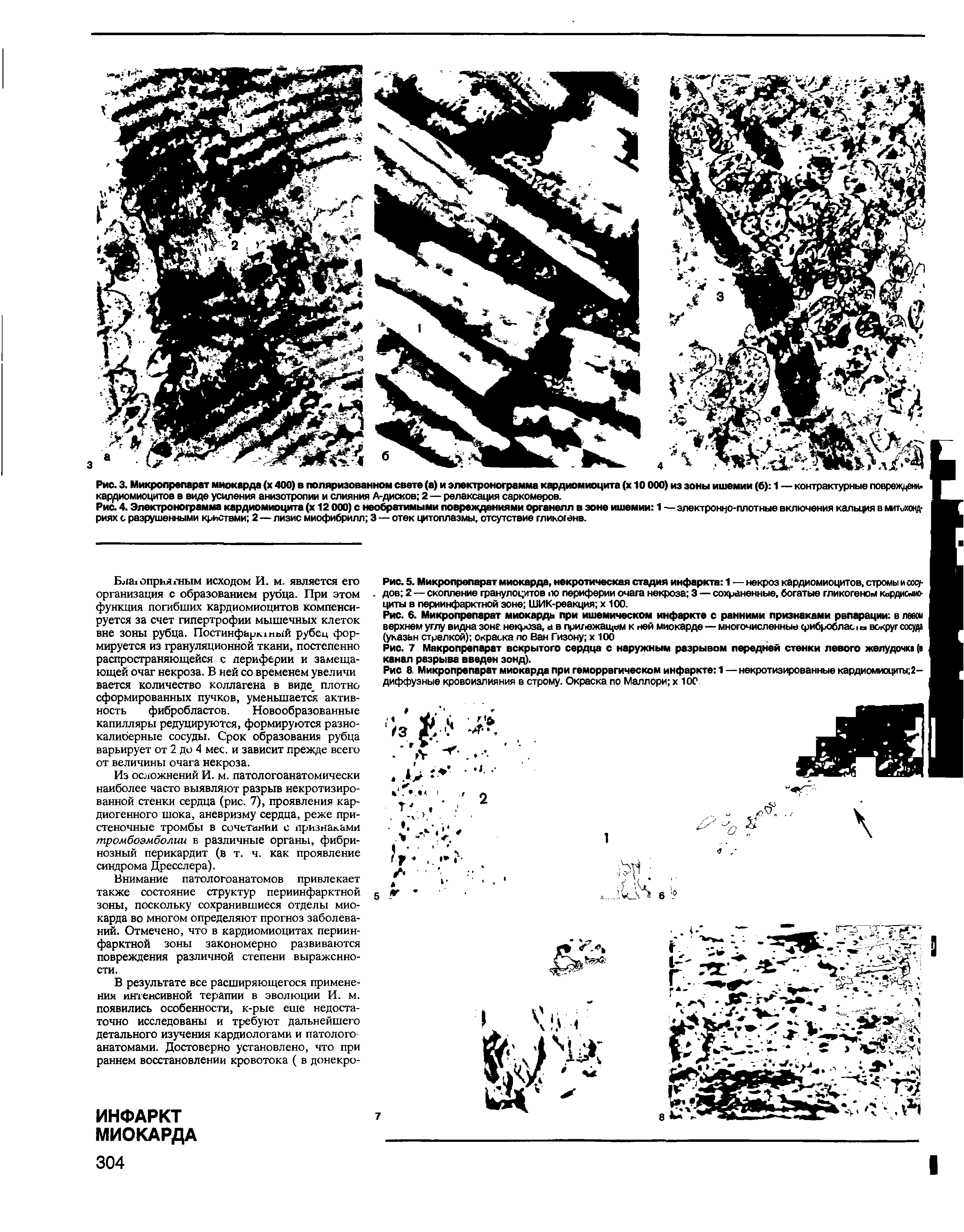 Рис. 5. Микропрепарат миокарда, некротическая стадия инфаркта 1 — некроз кардиомиоцитов, стромы и сосудов 2 — скопление гранулоцитов <ю периферии очага некроза 3 — сохраненные, богатые гликогеном кьрдимио-циты в периинфарктной зоне ШИК-реакция х 100.