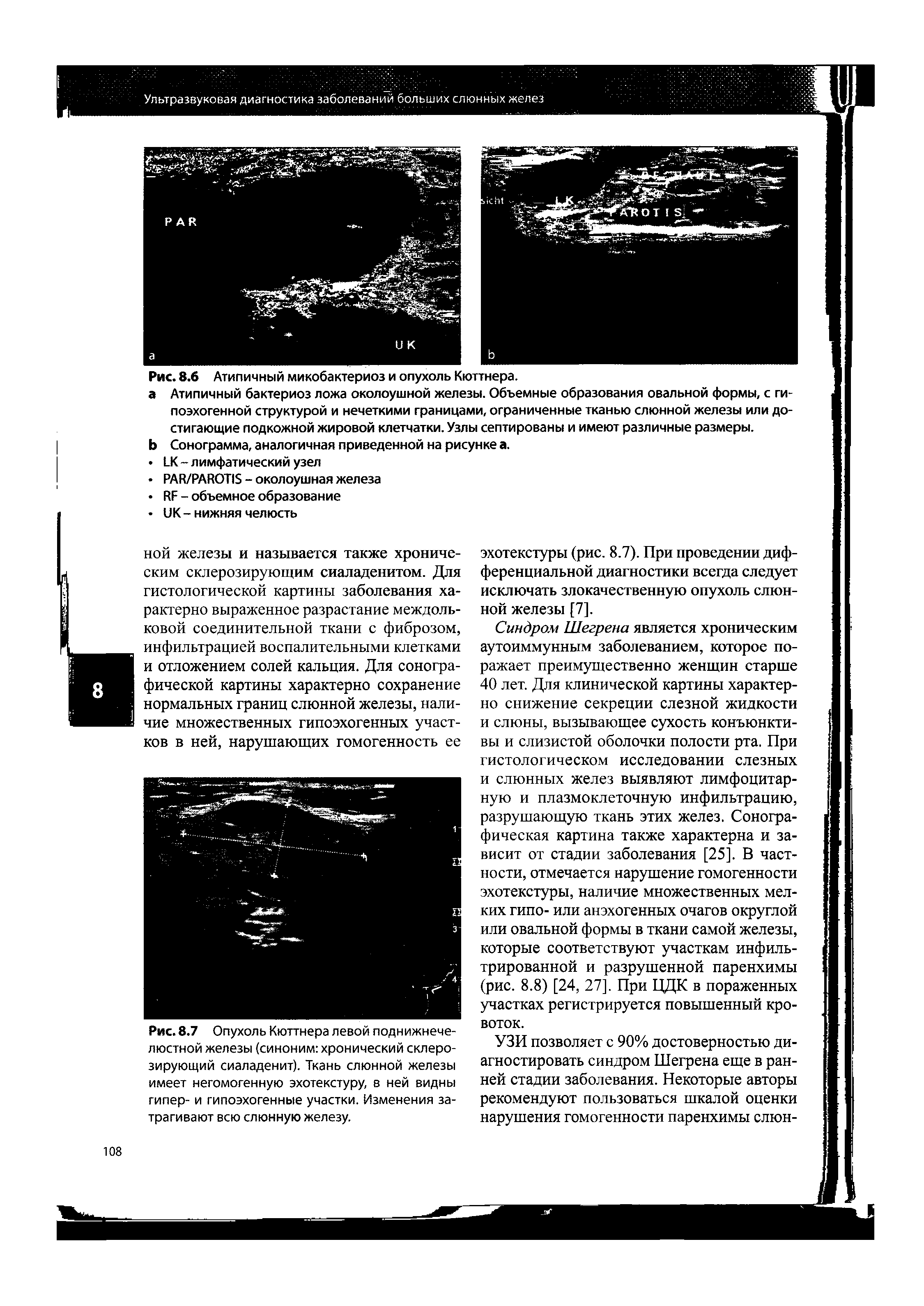 Рис. 8.7 Опухоль Кюттнера левой поднижнечелюстной железы (синоним хронический склерозирующий сиаладенит). Ткань слюнной железы имеет негомогенную эхотекстуру, в ней видны гипер- и гипоэхогенные участки. Изменения затрагивают всю слюнную железу.