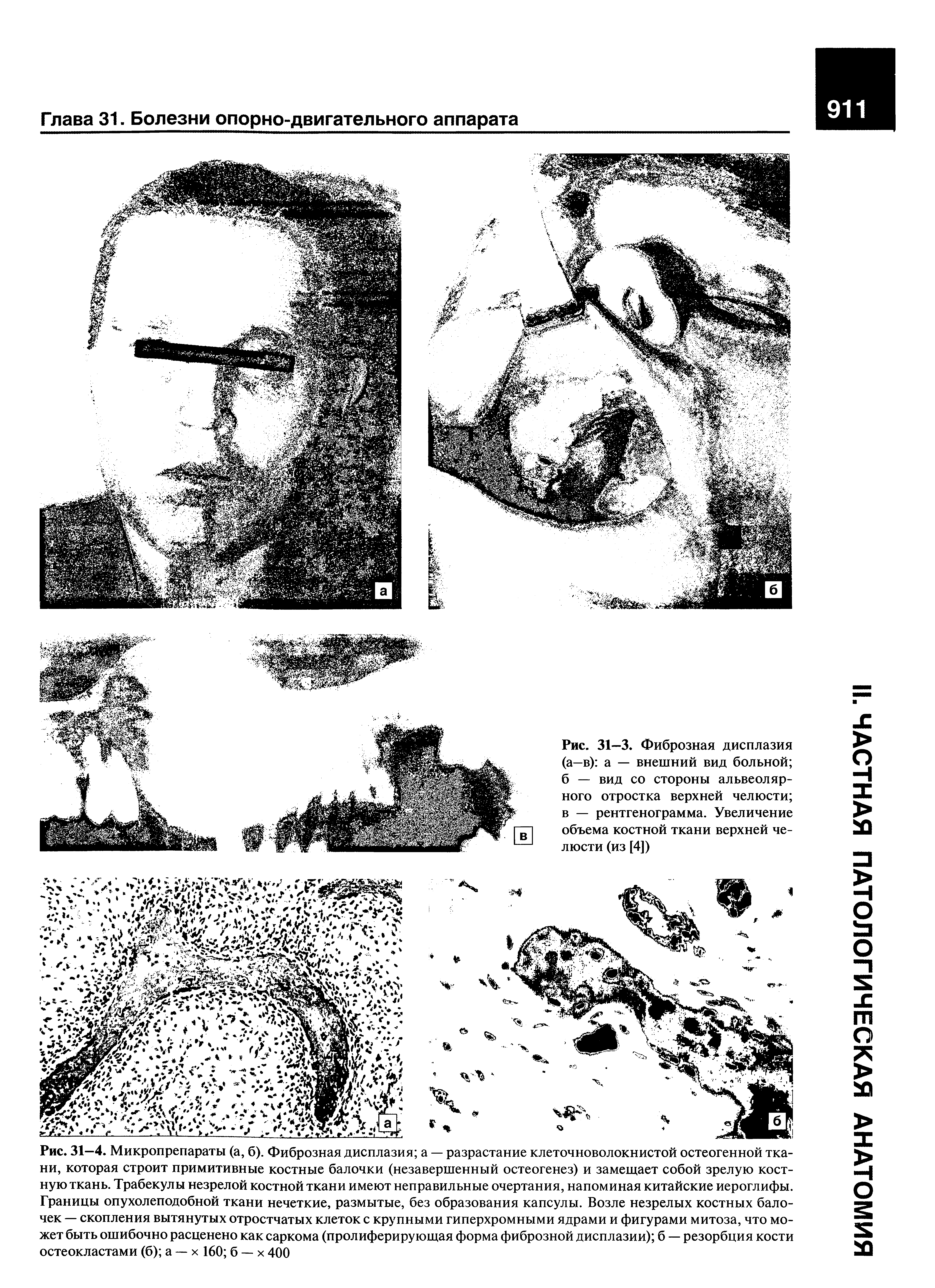 Рис. 31-3. Фиброзная дисплазия (а—в) а — внешний вид больной б — вид со стороны альвеолярного отростка верхней челюсти в — рентгенограмма. Увеличение объема костной ткани верхней челюсти (из [4])...