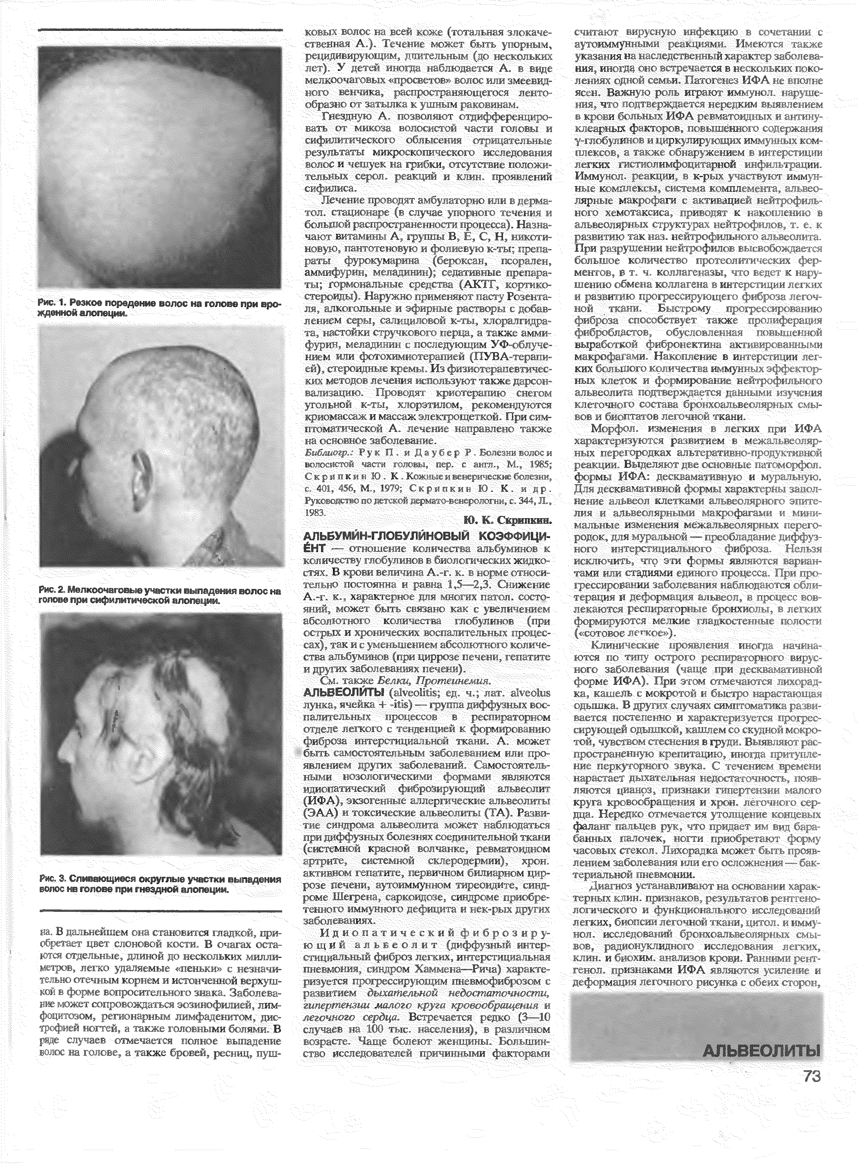 Рис. 2. Мелкоочаговые участки выпадения волос на голове при сифилитической алопеции.