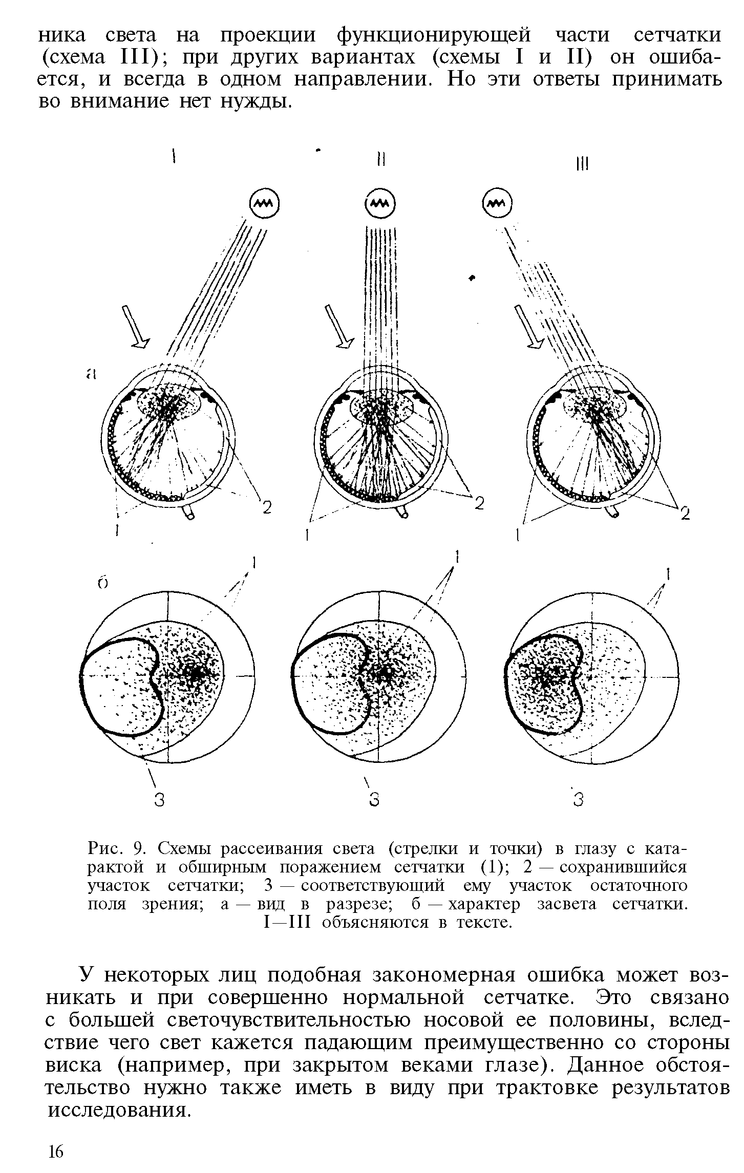 Рис. 9. Схемы рассеивания света (стрелки и точки) в глазу с катарактой и обширным поражением сетчатки (1) 2 — сохранившийся участок сетчатки 3 — соответствующий ему участок остаточного поля зрения а — вид в разрезе б — характер засвета сетчатки. I—III объясняются в тексте.