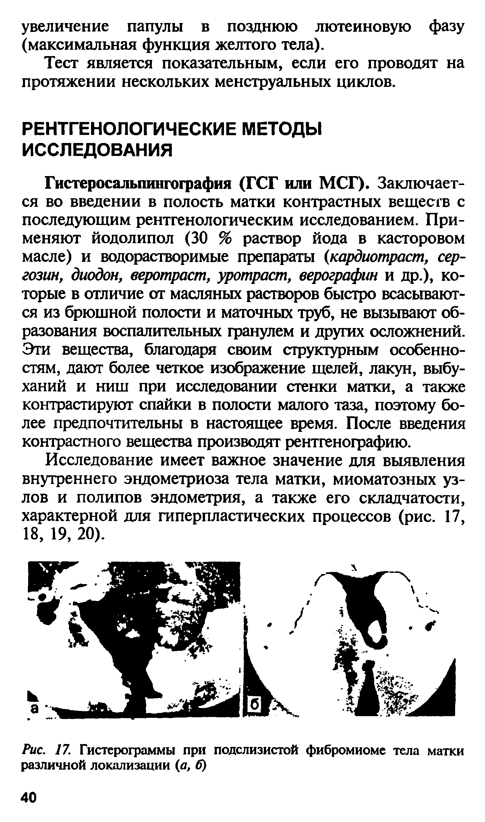 Рис. 17. Гистерограммы при подслизистой фибромиоме тела матки различной локализации (а, б)...