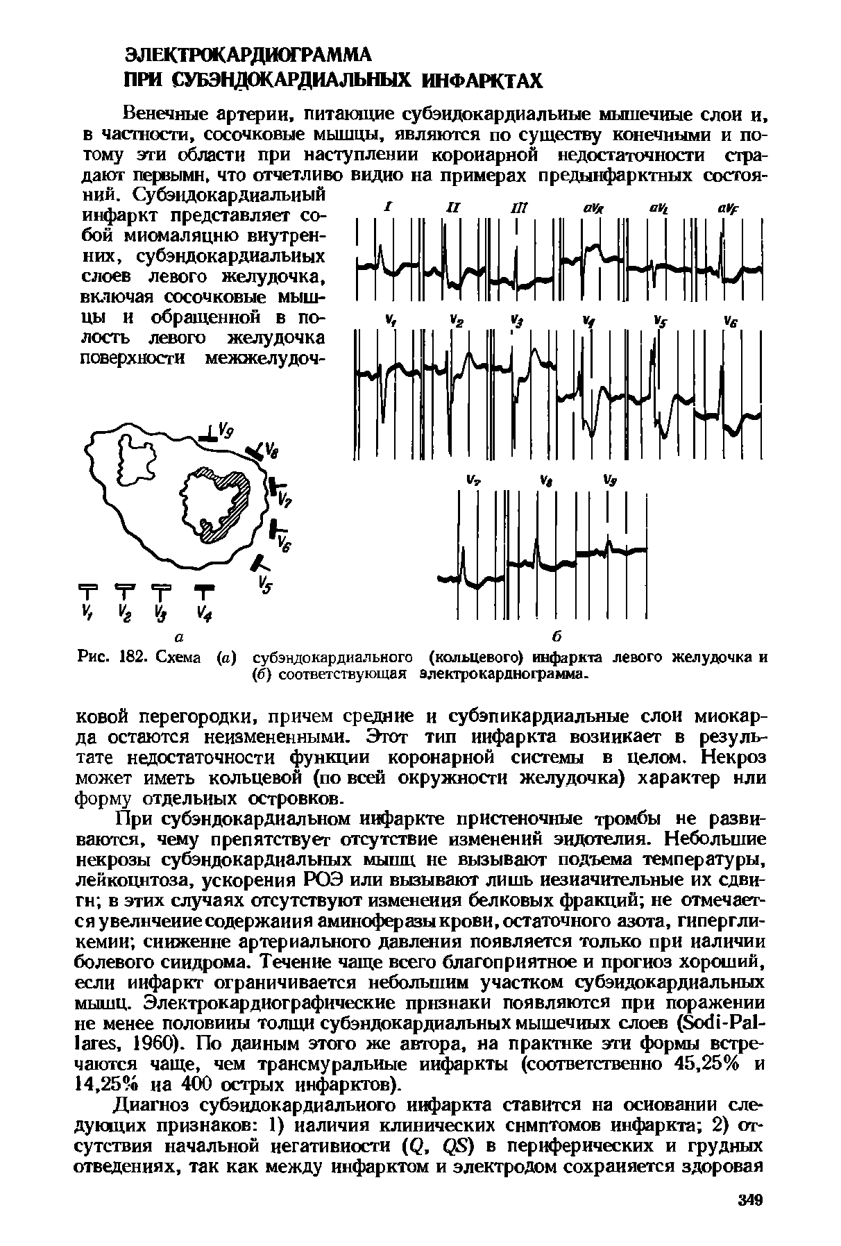 Рис. 182. Схема (а) субэндокардиального (кольцевого) инфаркта левого желудочка и (б) соответствующая электрокардиограмма.