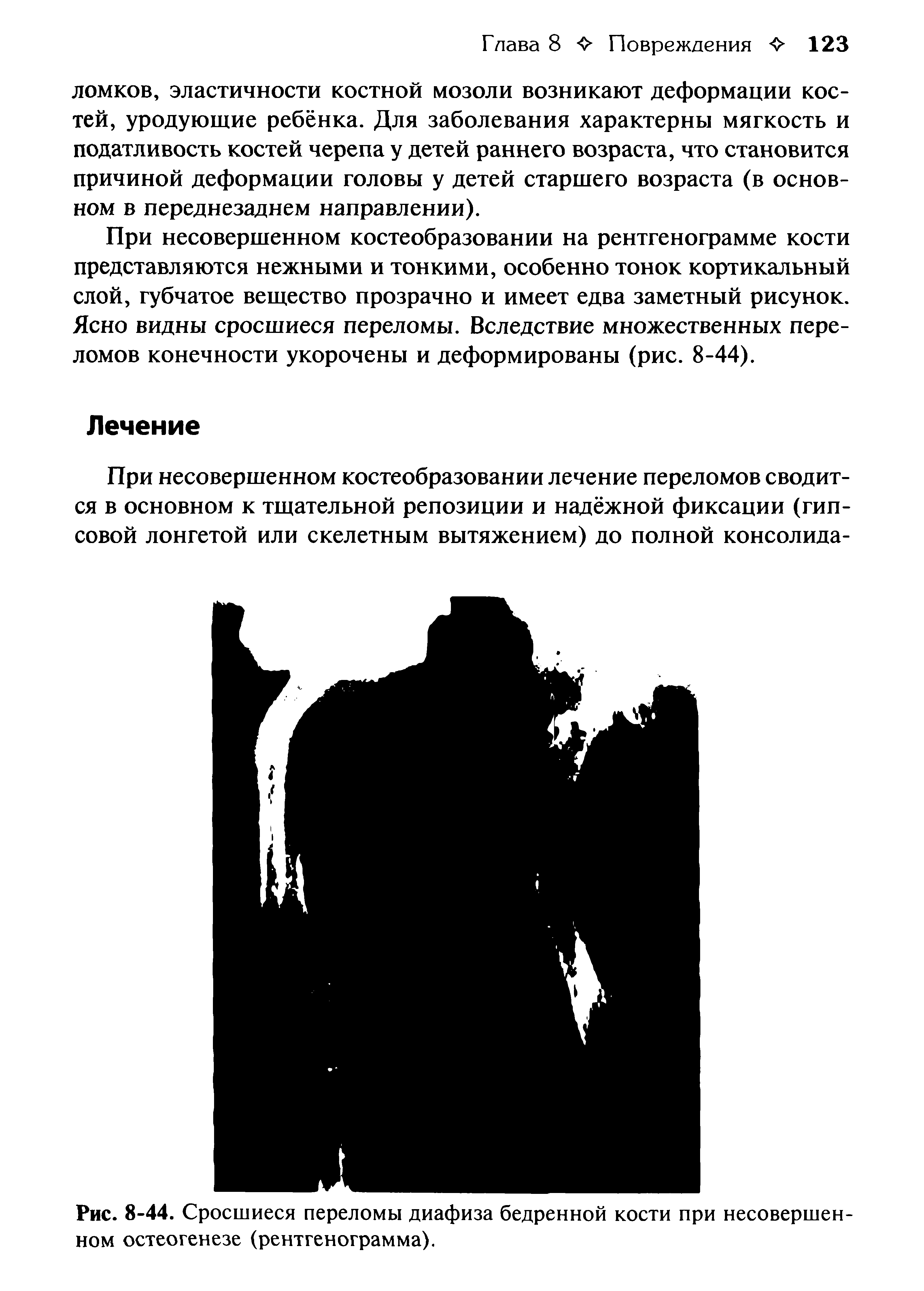 Рис. 8-44. Сросшиеся переломы диафиза бедренной кости при несовершенном остеогенезе (рентгенограмма).