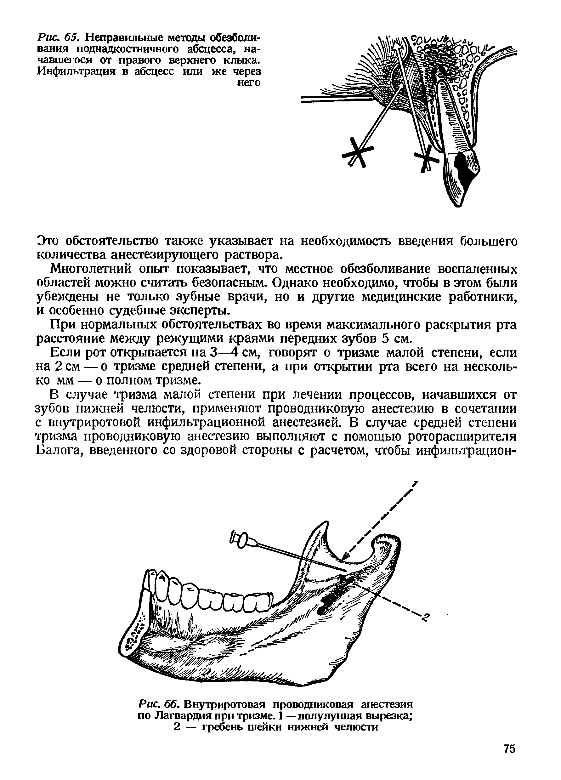 Рис. 66. Внутриротовая проводниковая анестезия по Лагвардия при тризме. 1 — полулунная вырезка 2 — гребень шейки нижней челюсти...