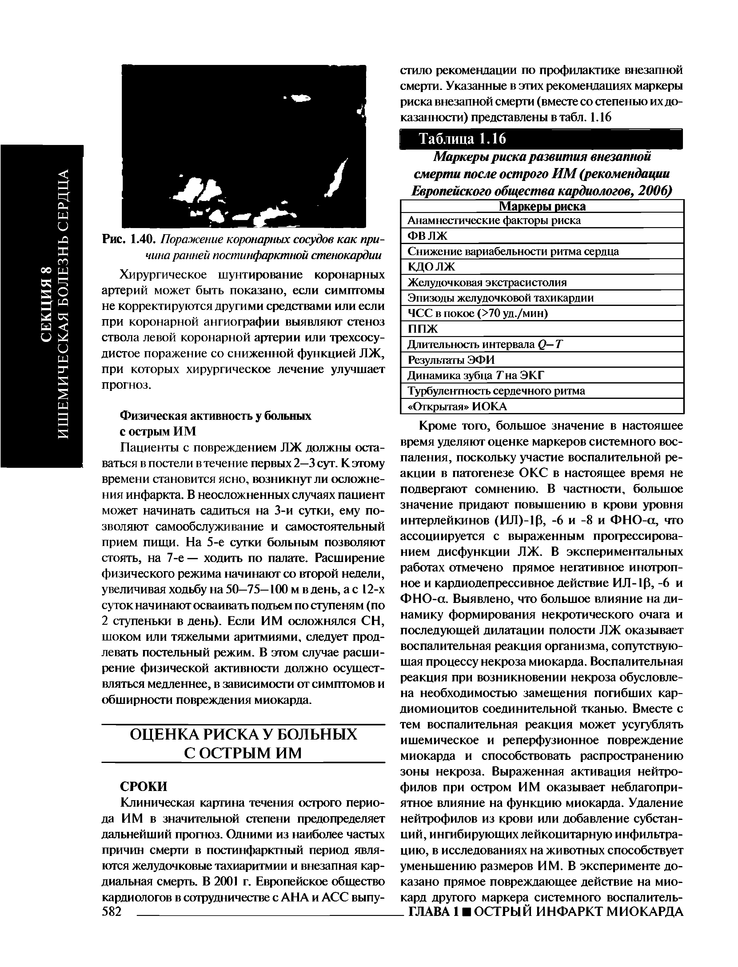 Рис. 1.40. Поражение коронарных сосудов как причина ранней постинфарктной стенокардии...