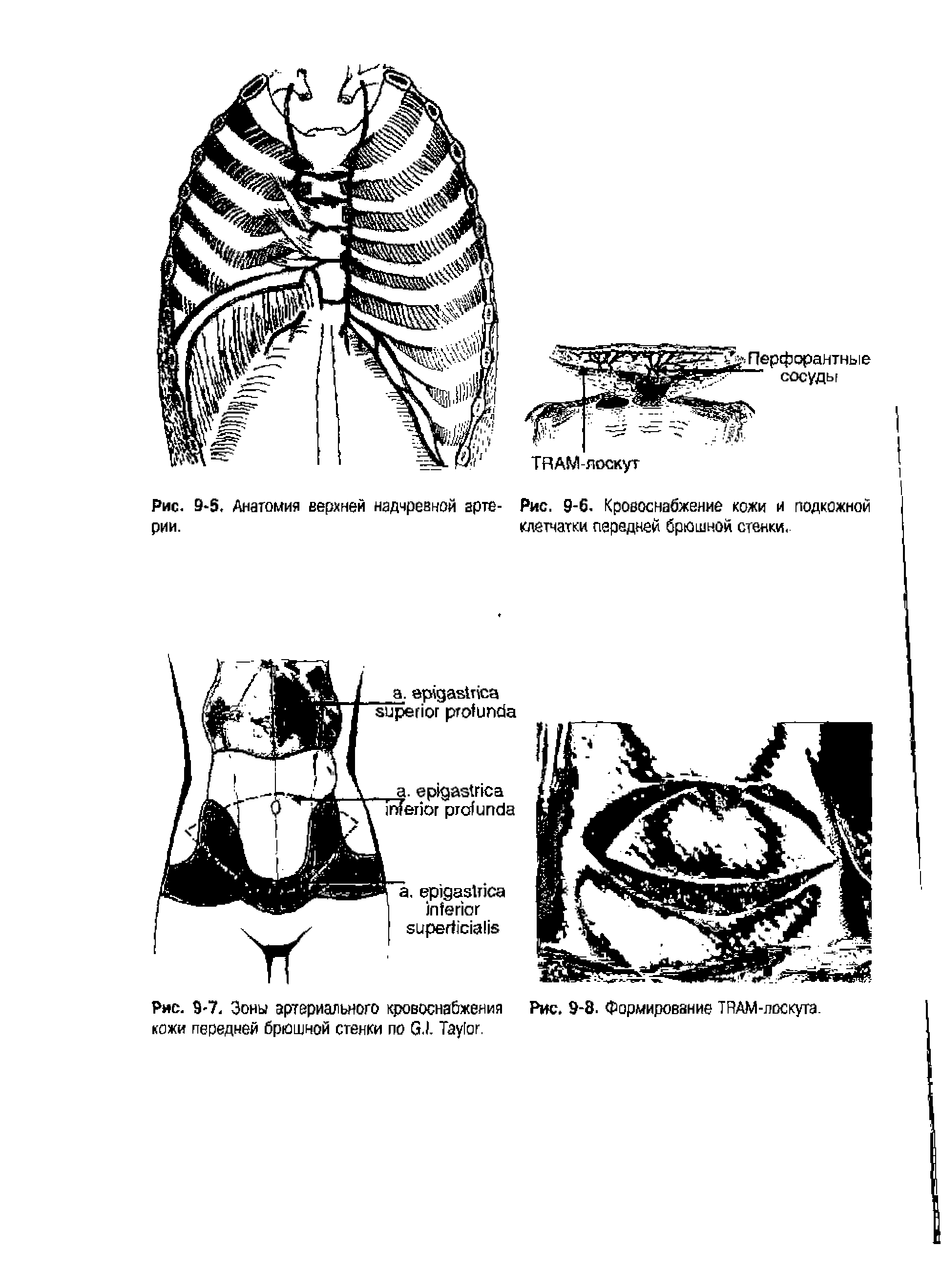 Рис. 9-7. Зоны артериального кровоснабжения Рис. 9-8. Формирование TRAM-лоскута. кожи передней брюшной стенки по G. . T .