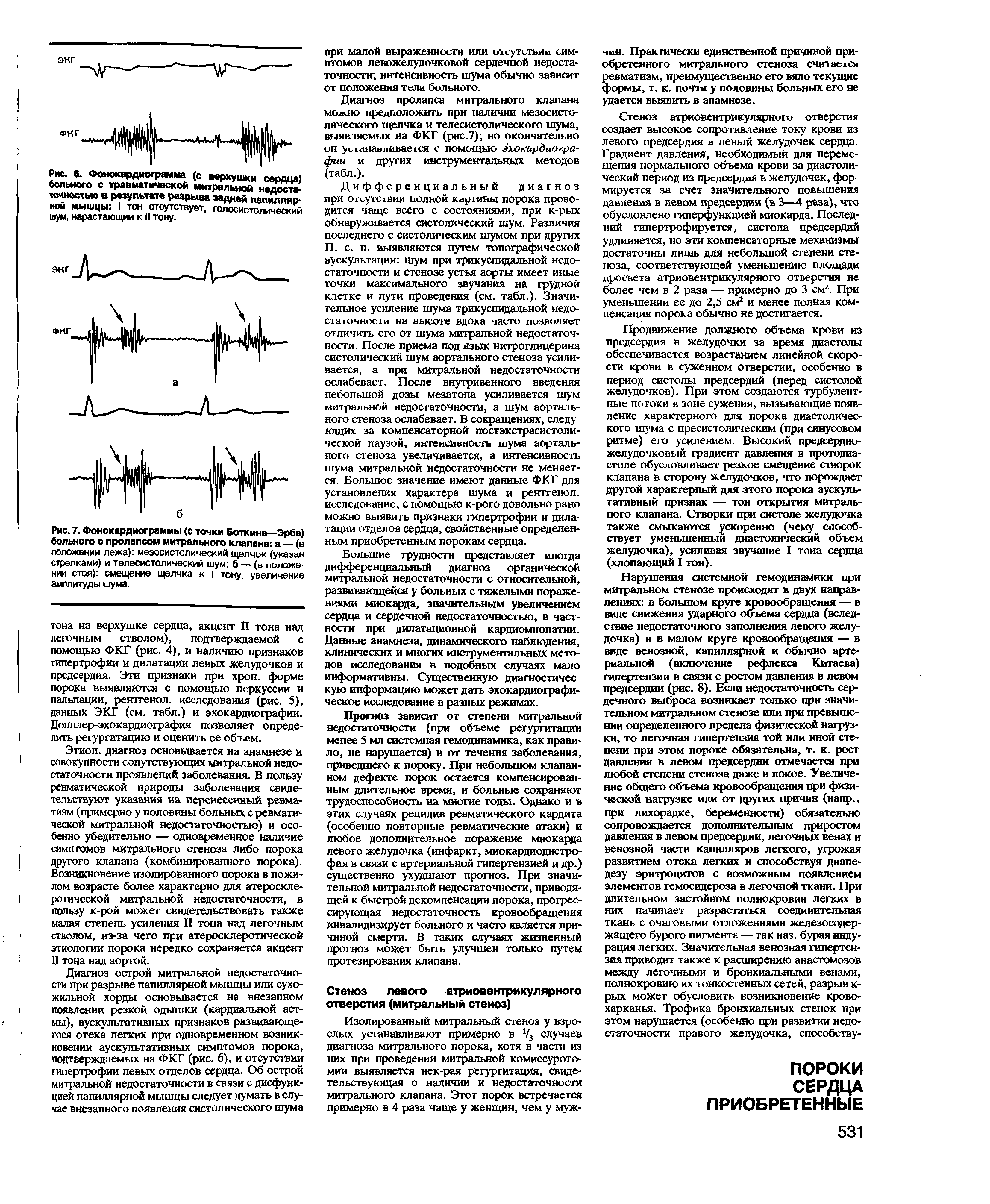 Рис. 7. Фонокардиограммы (с точки Боткина—Эрба) больного с пролапсом митрального клапана а — (в положении лежа) мезосистолический щелчок (указан стрелками) и телесистолический шум б — (в положении стоя) смещение щелчка к I тону, увеличение амплитуды шума.