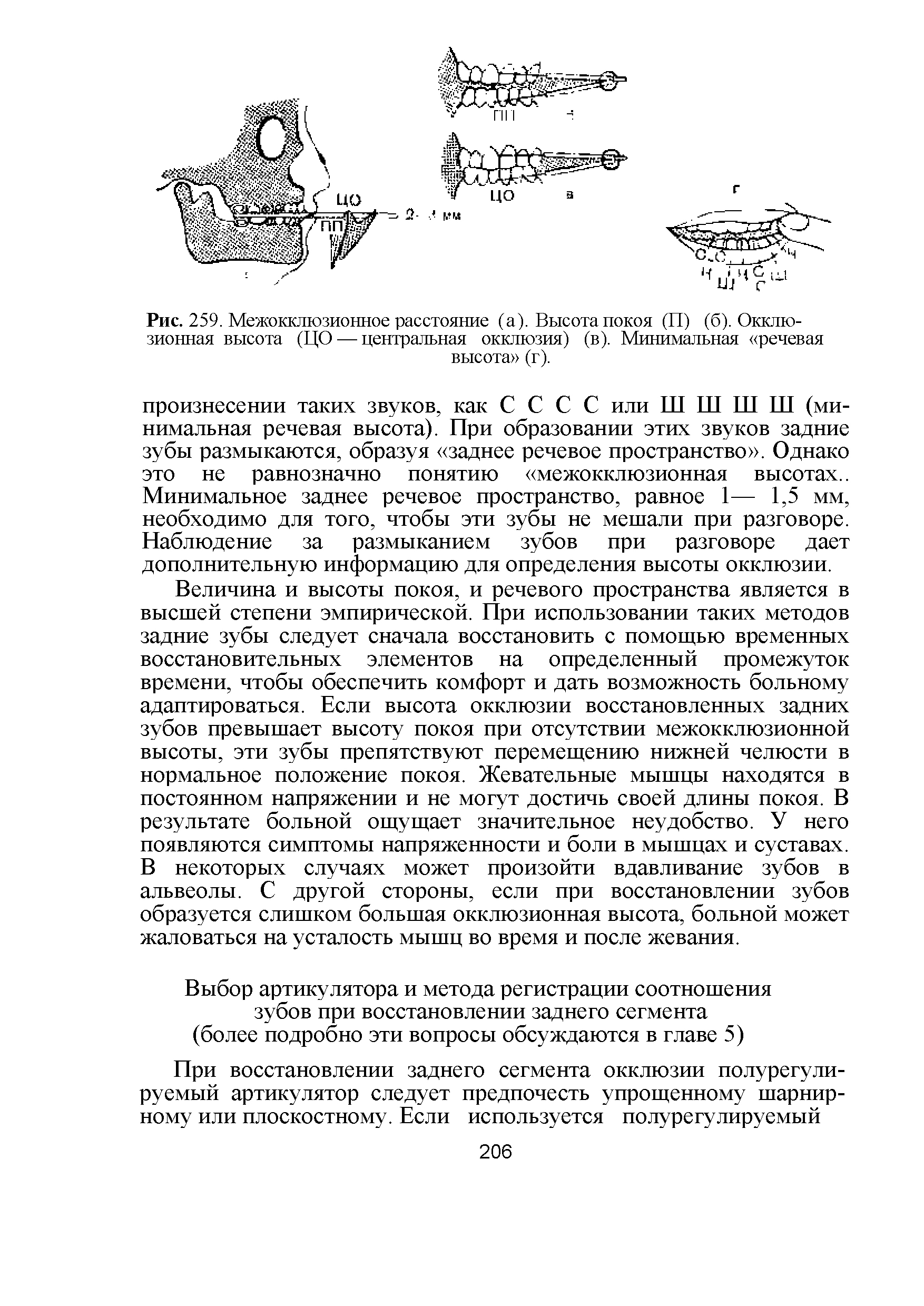 Рис. 259. Межокклюзионное расстояние (а). Высота покоя (П) (б). Окклюзионная высота (ЦО — центральная окклюзия) (в). Минимальная речевая высота (г).