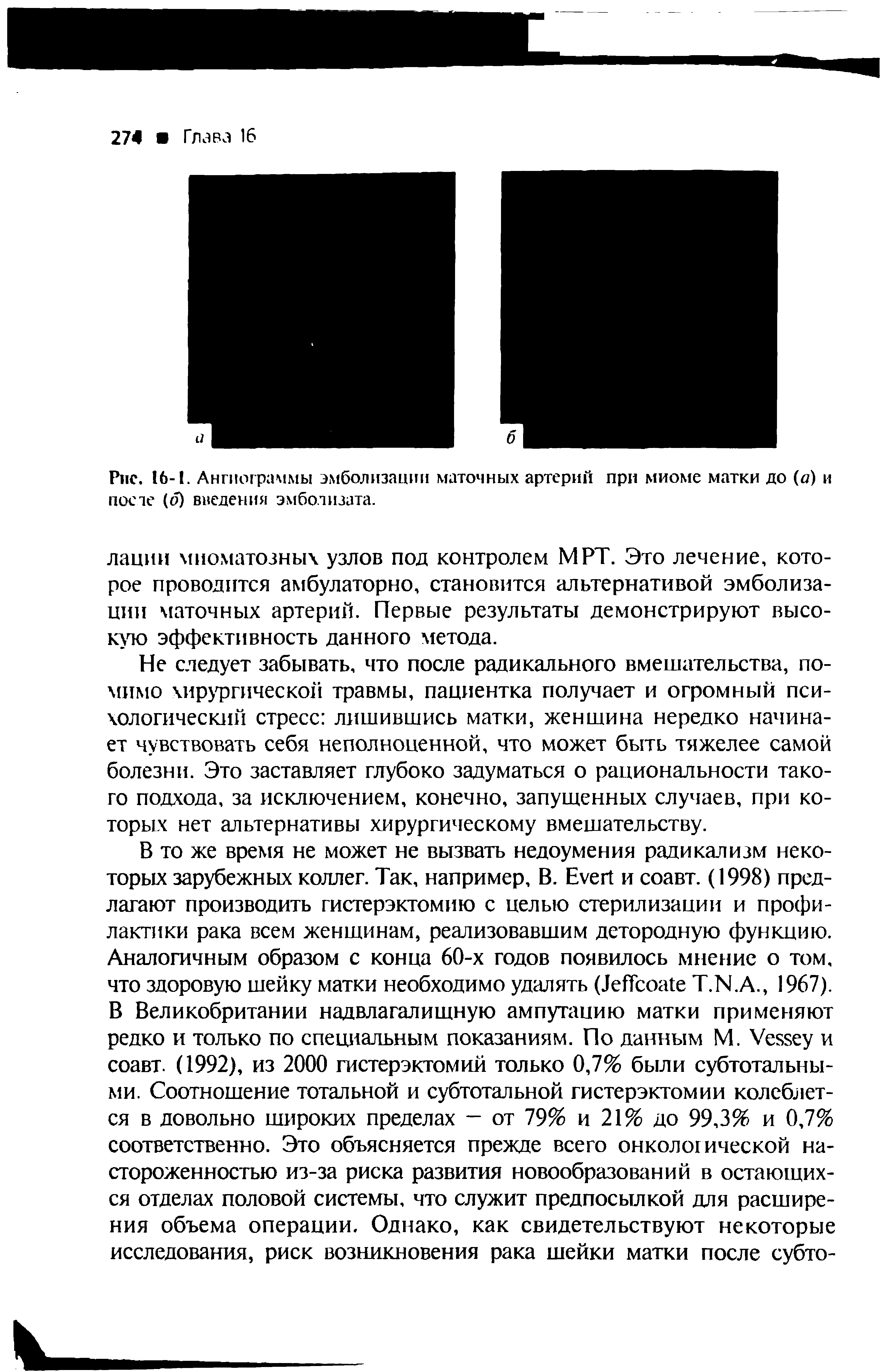 Рис. 16-1. Ангиограммы эмболизации маточных артерий при миоме матки до (а) и посте (о) введения эмбо.тизата.