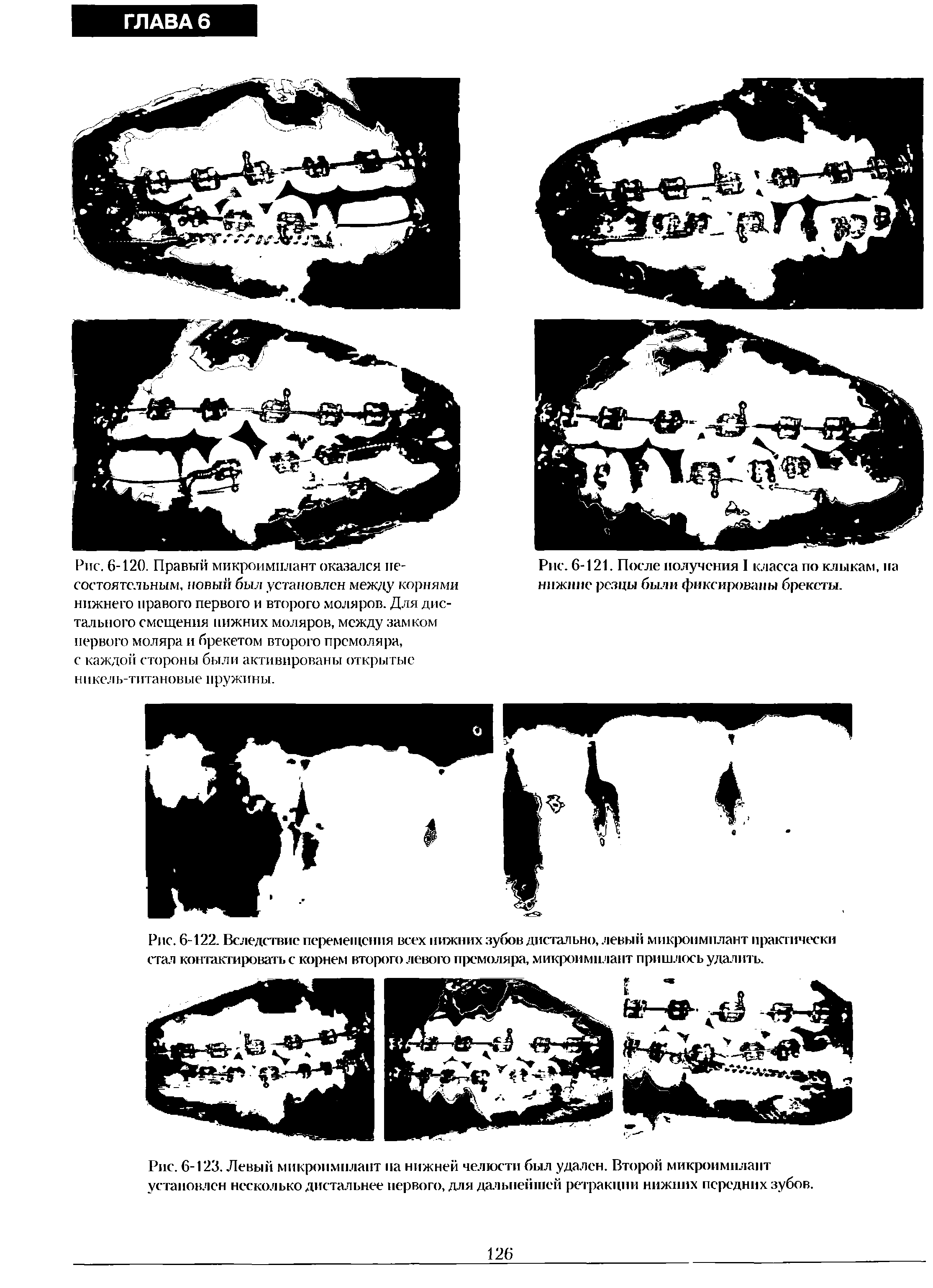 Рис. 6-123. Левый микроимнлапт иа нижней челюсти был удален. Второй микроимнлапт установлен несколько дистальнее первого, для дальнейшей ретракции нижних передних зубов.