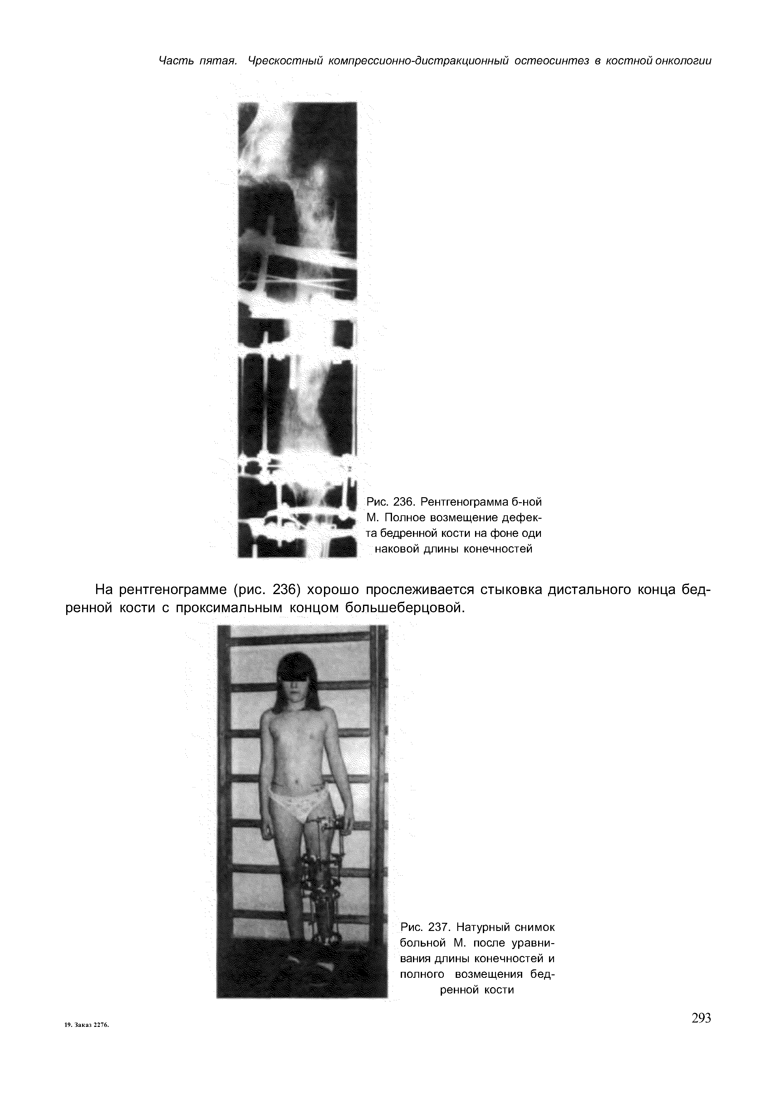 Рис. 236. Рентгенограмма б-ной М. Полное возмещение дефекта бедренной кости на фоне оди наковой длины конечностей...