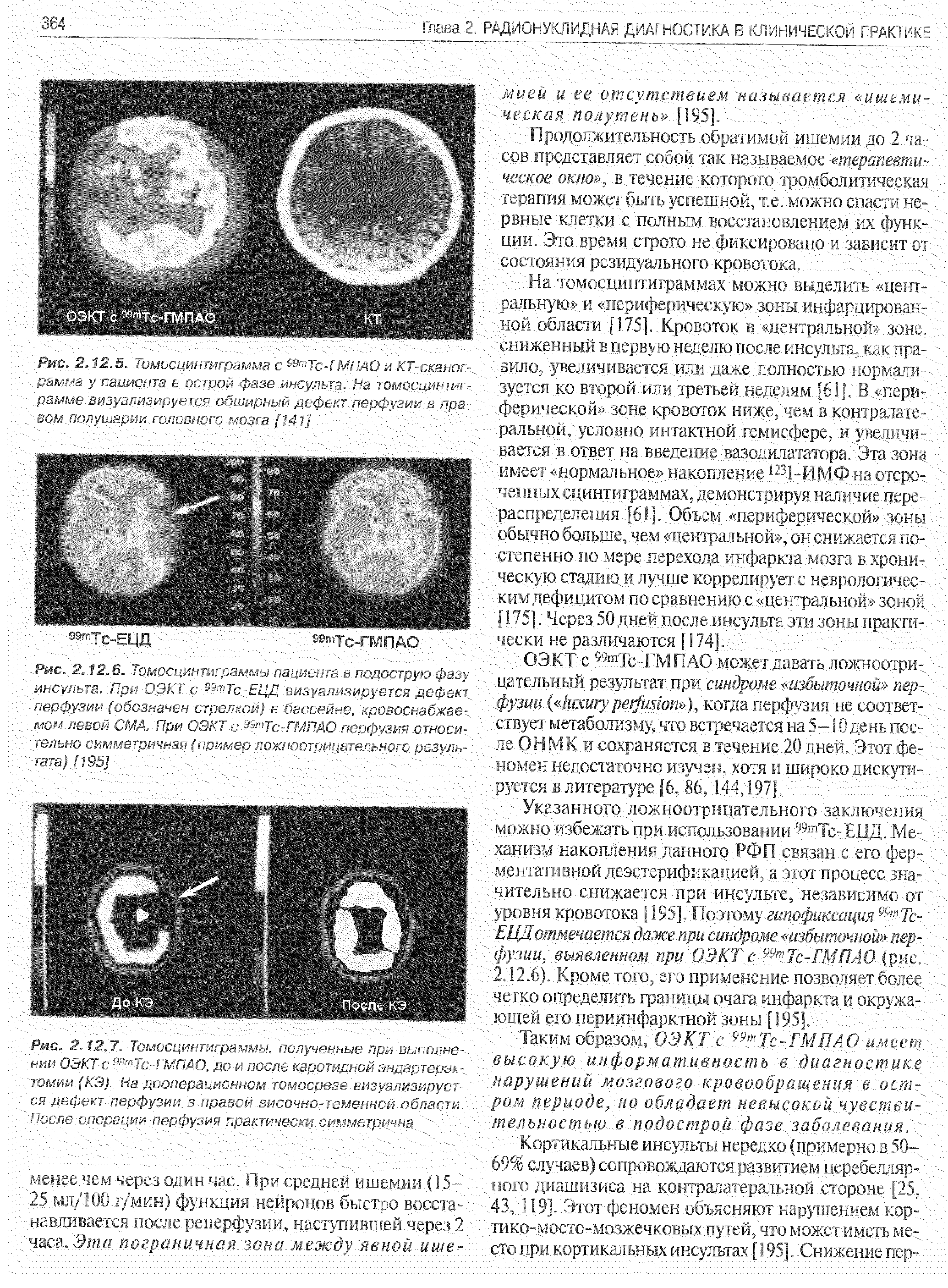 Рис. 2.12,7. Томосцинтиграммы. полученные при выполнении ОЭКТ с Тс-ГМПАО, до и после каротидной эндартерэк-. томии (КЗ). На дооперационном томосрезе визуализируется дефект перфузии в правой височно-теменной области. После операции перфузия практически симметрична г...