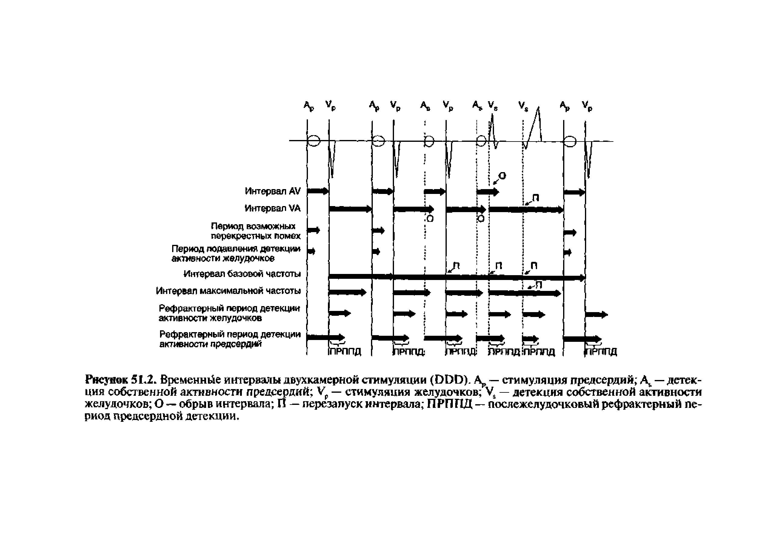 Рисунок 51.2. Временное интервалы двухкамерной стимуляции (ООО). — стимуляция предсердий А —детекция собственной активности предсердий — стимуляция желудочков V. — детекция собственной активности желудочков О — обрыв интервала П — перезапуск интервала ПРППД — послежелудочковый рефрактерный период предсердной детекции.