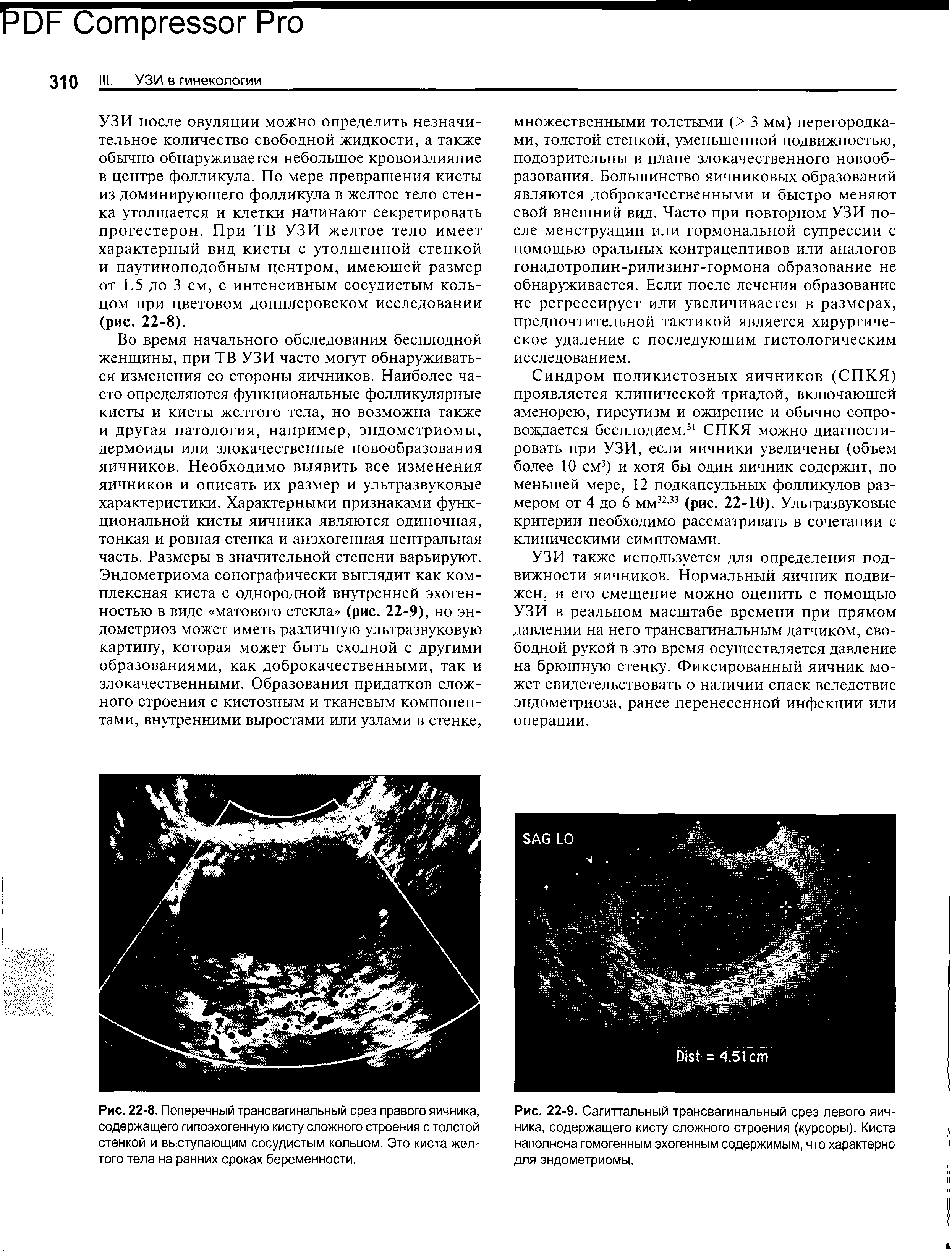 Рис. 22-9. Сагиттальный трансвагинальный срез левого яичника, содержащего кисту сложного строения (курсоры). Киста наполнена гомогенным эхогенным содержимым, что характерно для эндометриомы.