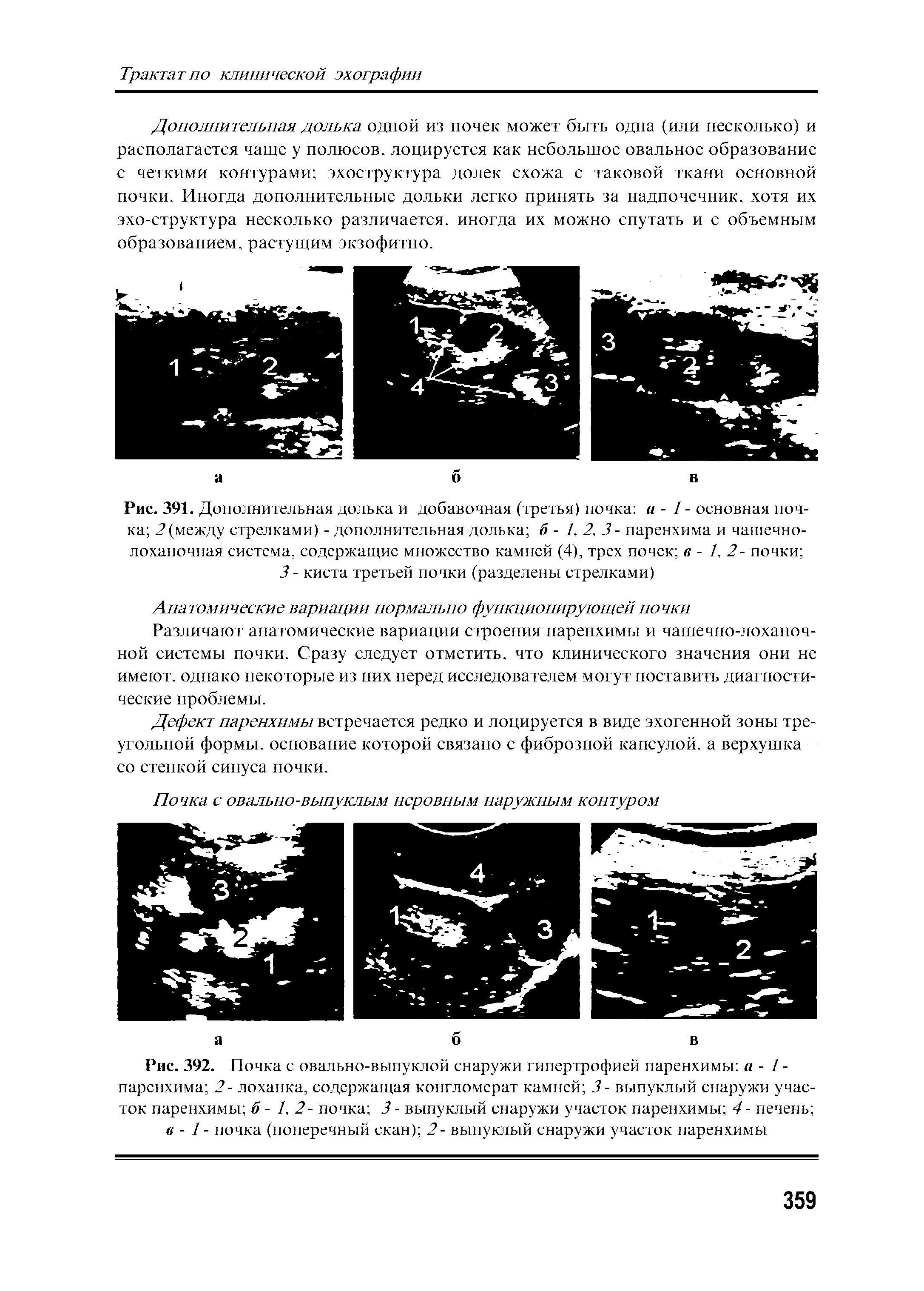 Рис. 391. Дополнительная долька и добавочная (третья) почка а - 1 - основная почка 2(между стрелками) - дополнительная долька б - 1, 2, 3- паренхима и чашечнолоханочная система, содержащие множество камней (4), трех почек в - 1, 2- почки ...