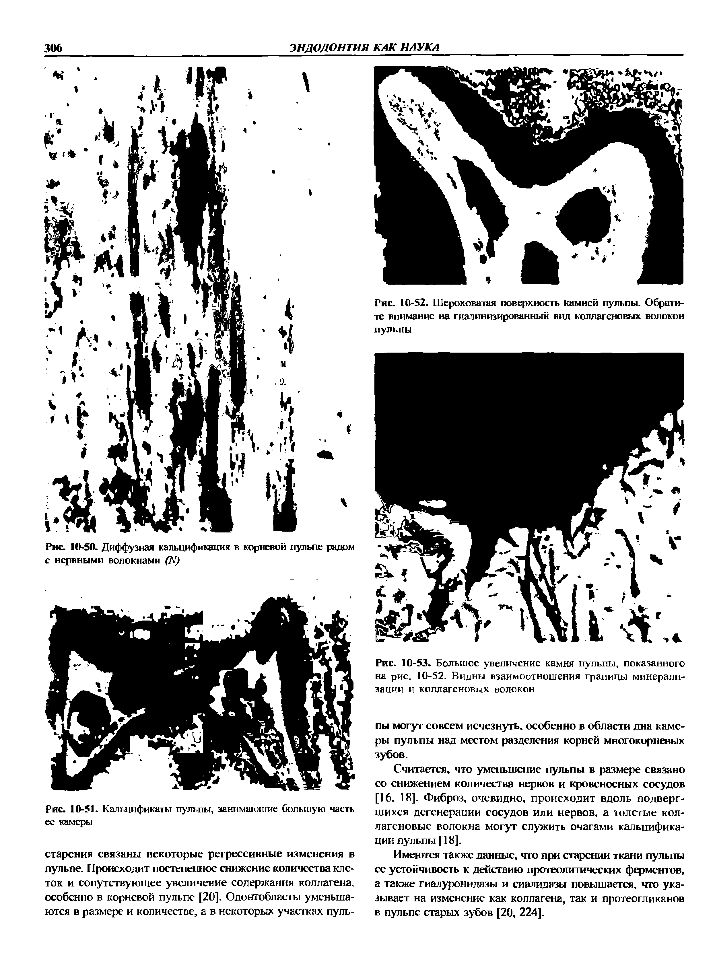 Рис. 10-51. Кальцификаты пульпы, занимающие большую часть ее камеры...