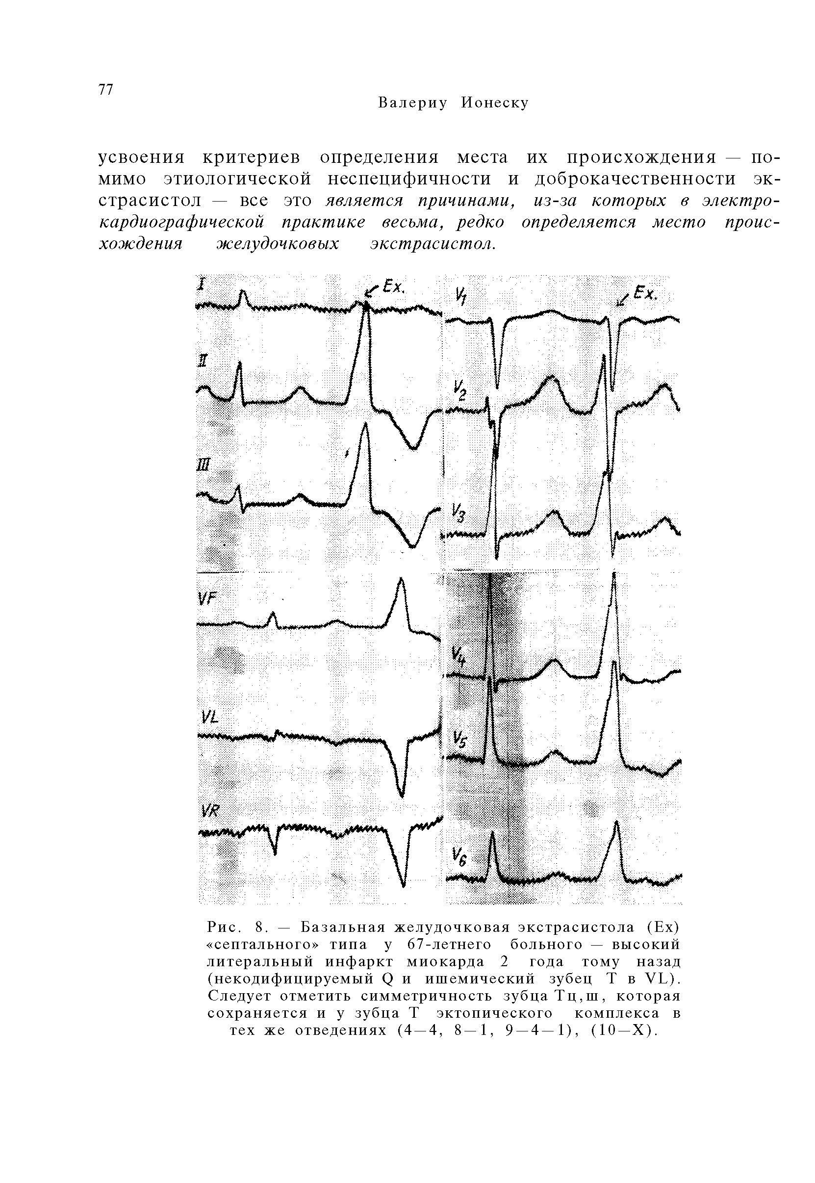 Рис. 8. — Базальная желудочковая экстрасистола (Ех) септального типа у 67-летнего больного — высокий литеральный инфаркт миокарда 2 года тому назад (некодифицируемый (2 и ишемический зубец Т в УЬ). Следует отметить симметричность зубца Тц,ш, которая сохраняется и у зубца Т эктопического комплекса в тех же отведениях (4 — 4, 8—1, 9 — 4—1), (10—X).