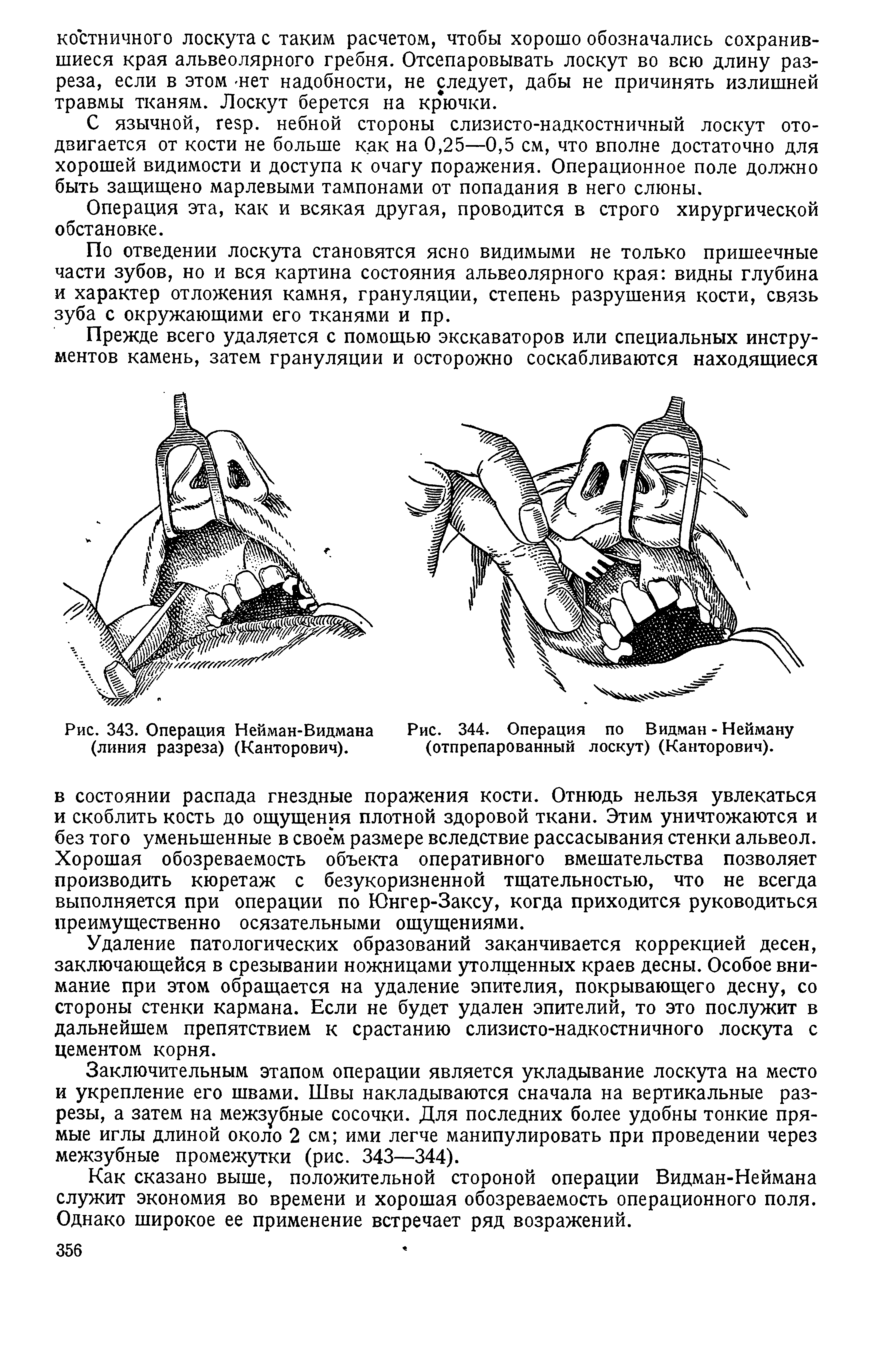 Рис. 344. Операция по Видман - Нейману (отпрепарованный лоскут) (Канторович).