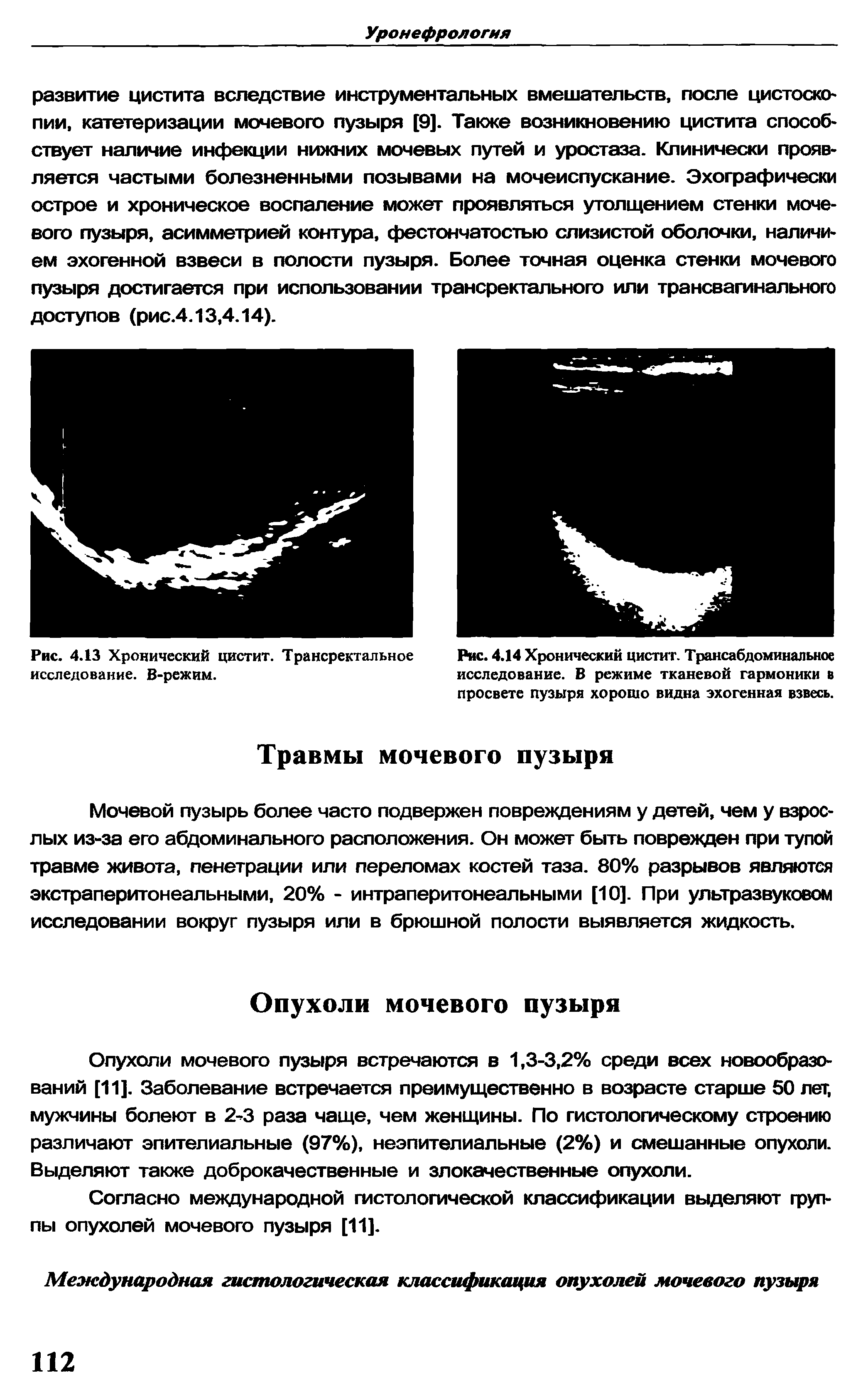 Рис. 4.14 Хронический цистит. Трансабдоминальное исследование. В режиме тканевой гармоники в просвете пузыря хорошо видна эхогенная взвесь.