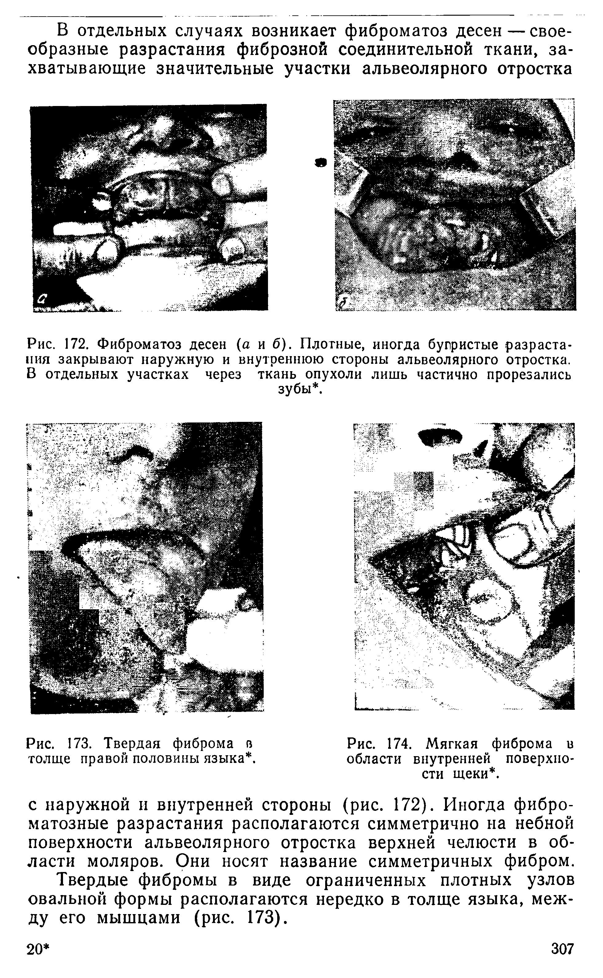 Рис. 173. Твердая фиброма в толще правой половины языка. ...