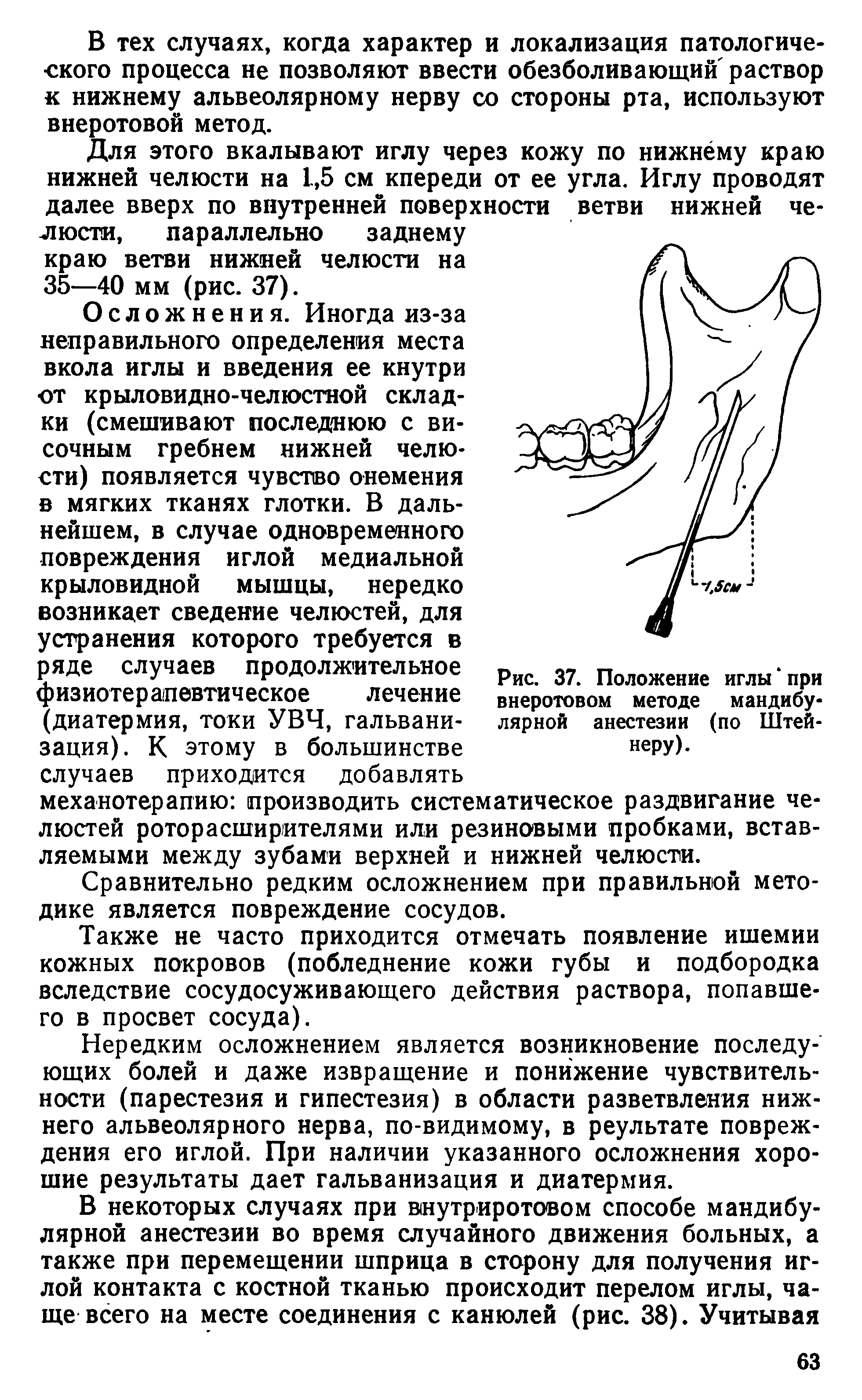 Рис. 37. Положение иглы при внеротовом методе мандибулярной анестезии (по Штейнеру).