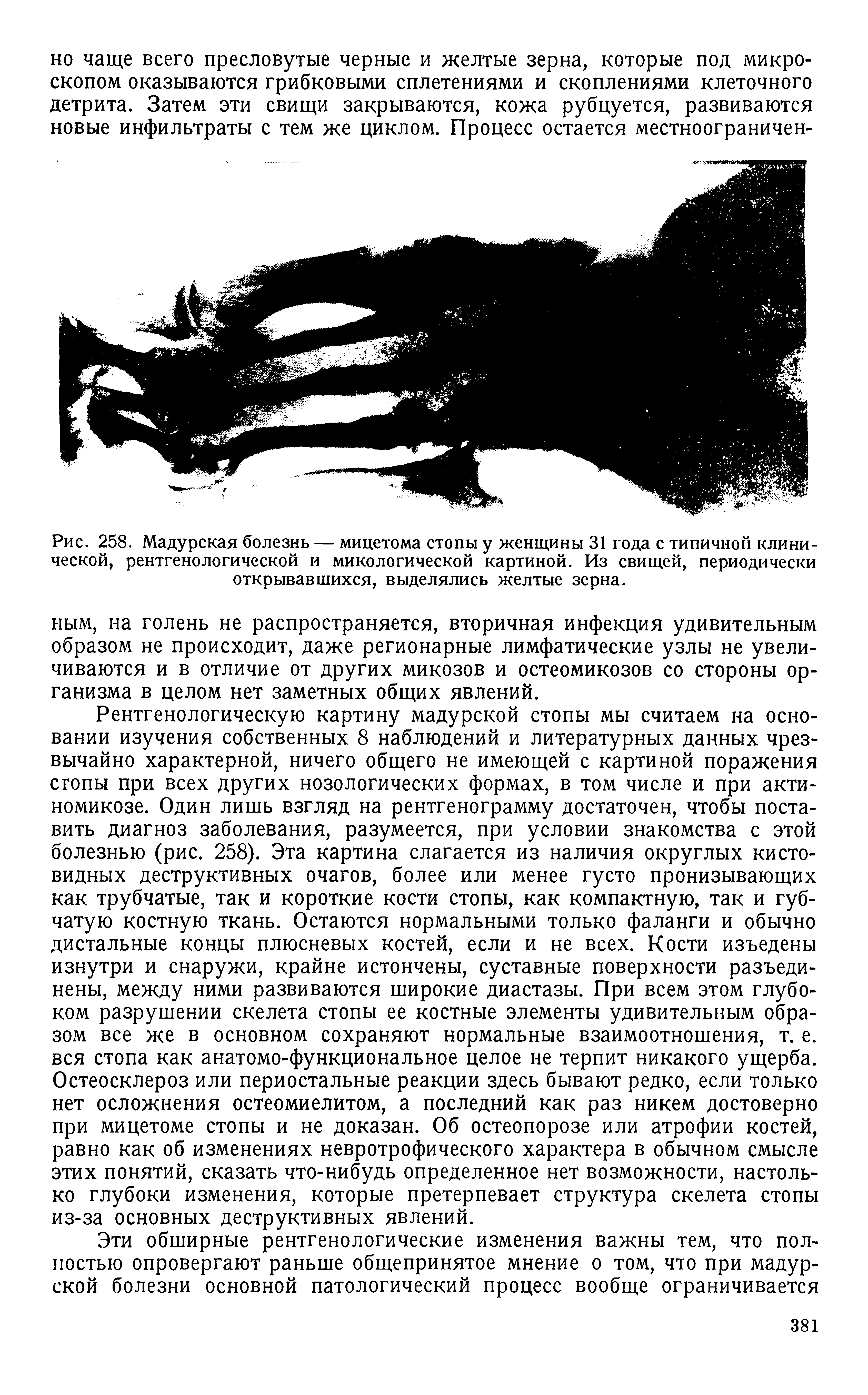 Рис. 258. Мадурская болезнь — мицетома стопы у женщины 31 года с типичной клинической, рентгенологической и микологической картиной. Из свищей, периодически открывавшихся, выделялись желтые зерна.