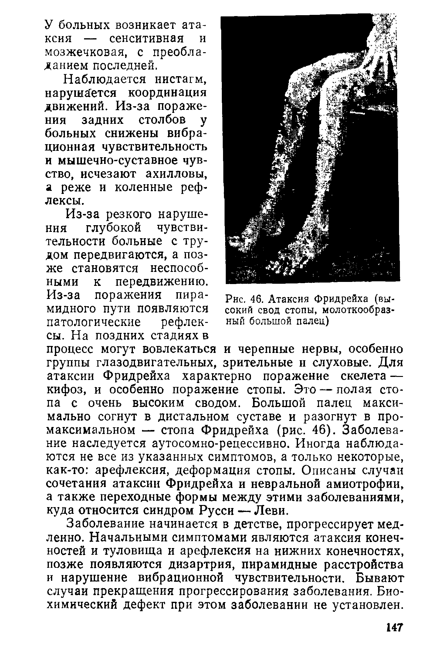 Рис. 46. Атаксия Фридрейха (высокий свод стопы, молоткообразный большой палец)...