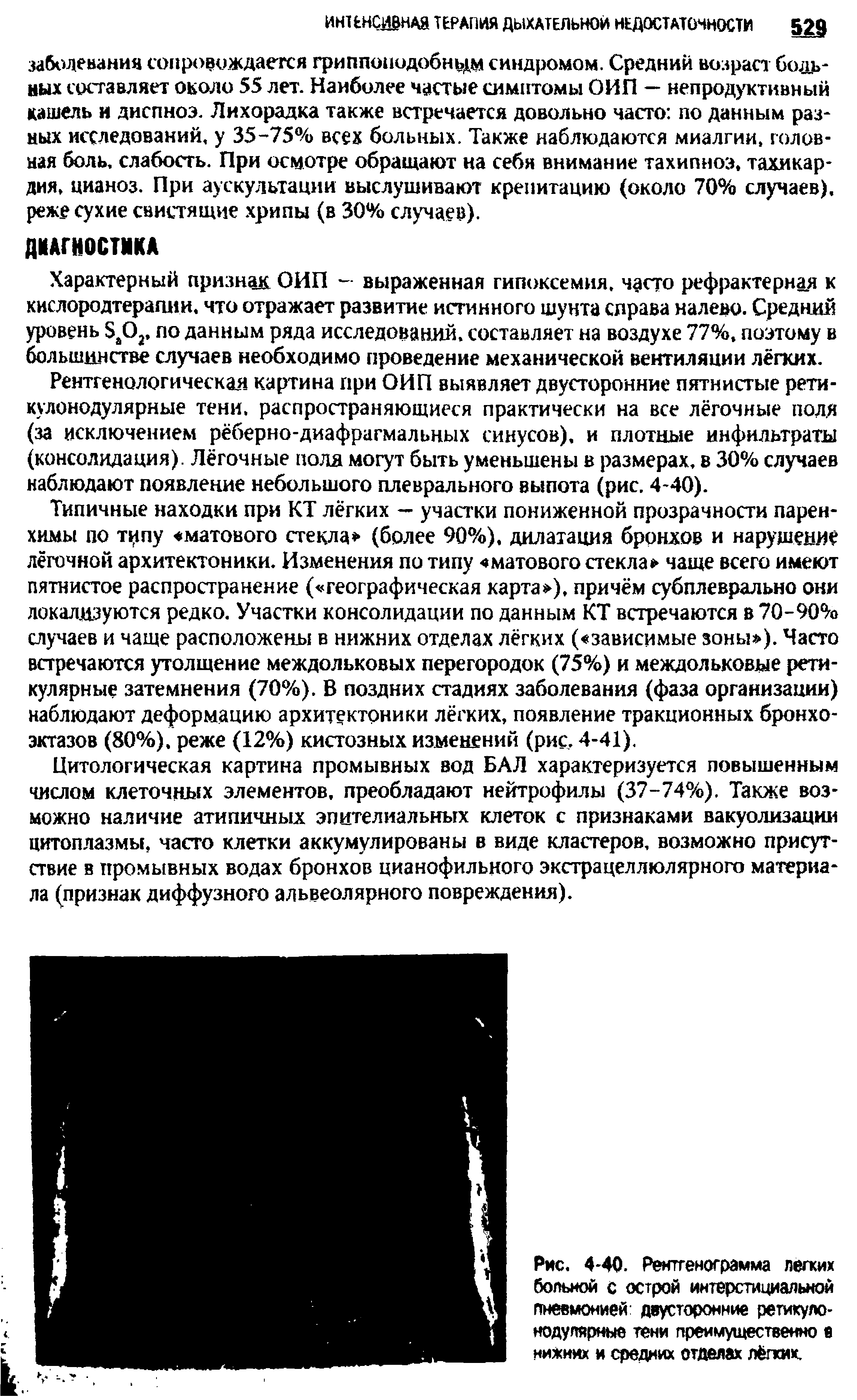 Рис. 4-40. Рентгенограмма легких больной с острой интерстициальной пневмонией двусторонние ретикуло-нодулярные тени преимущественно в нижних и средних отделах лёгких.