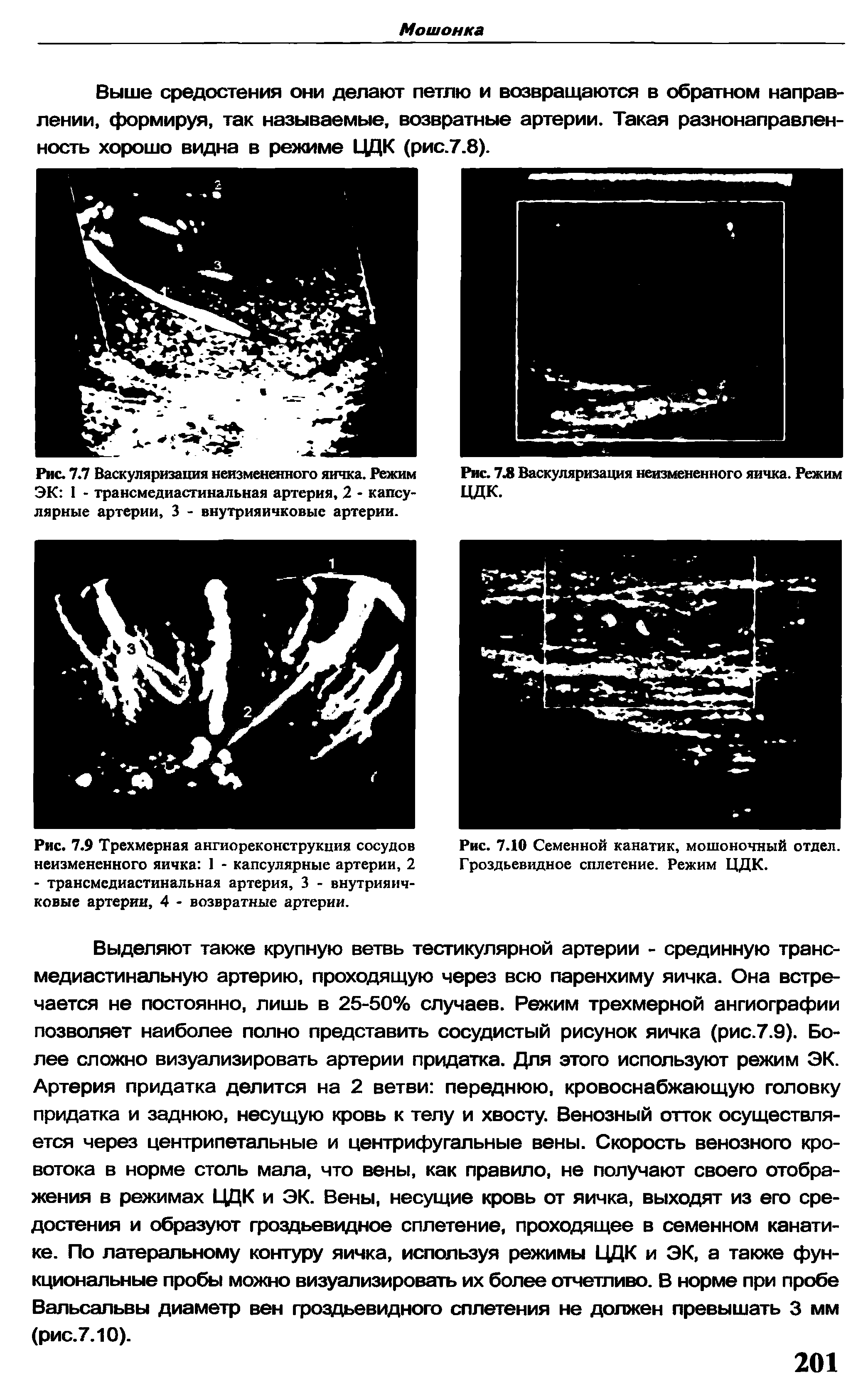 Рис. 7.7 Васкуляризация неизмененного яичка. Режим ЭК I - трансмедиастинальная артерия, 2 - капсулярные артерии, 3 - внутрияичковыс артерии.