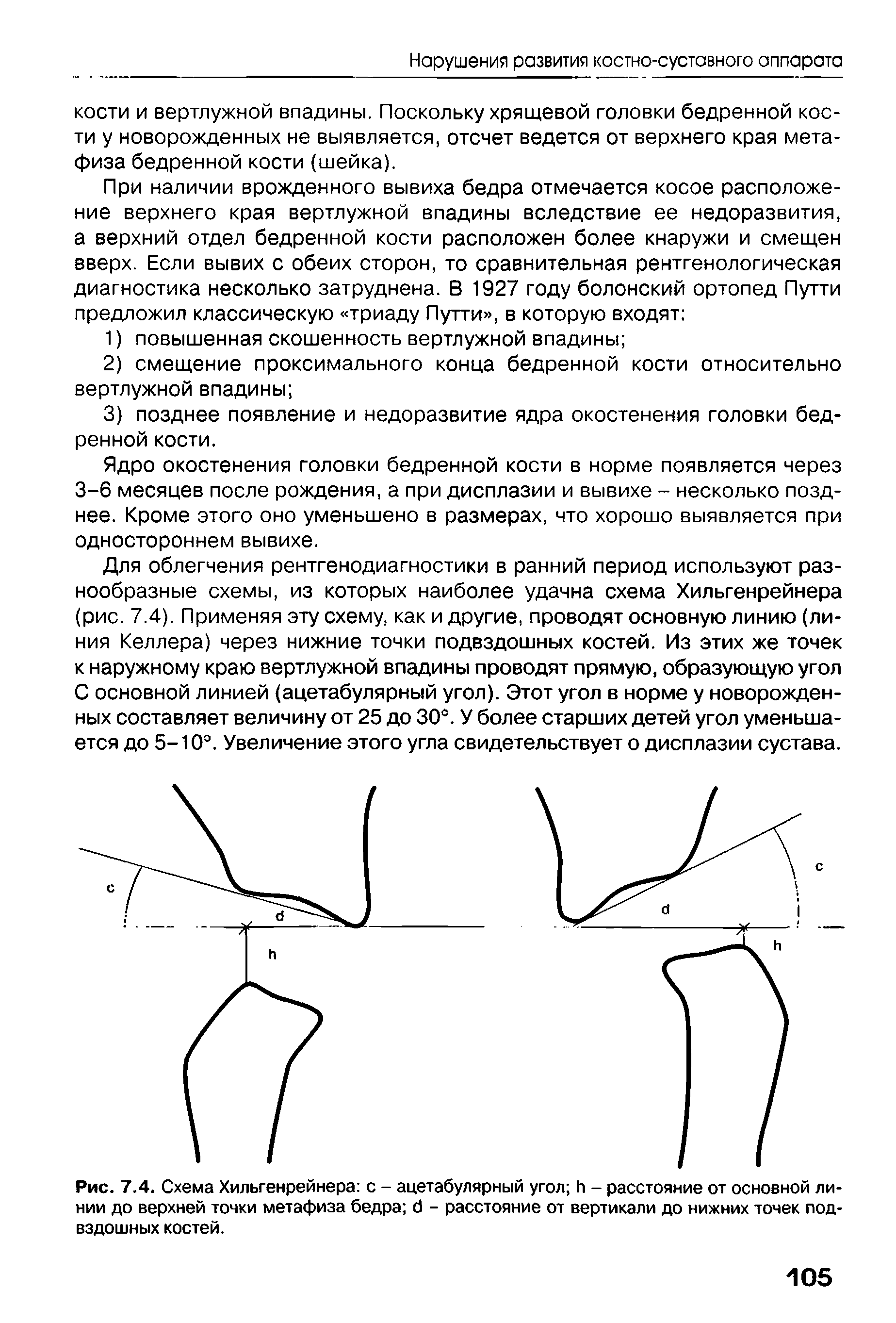 Рис. 7.4. Схема Хильгенрейнера с - ацетабулярный угол И - расстояние от основной линии до верхней точки метафиза бедра б - расстояние от вертикали до нижних точек подвздошных костей.