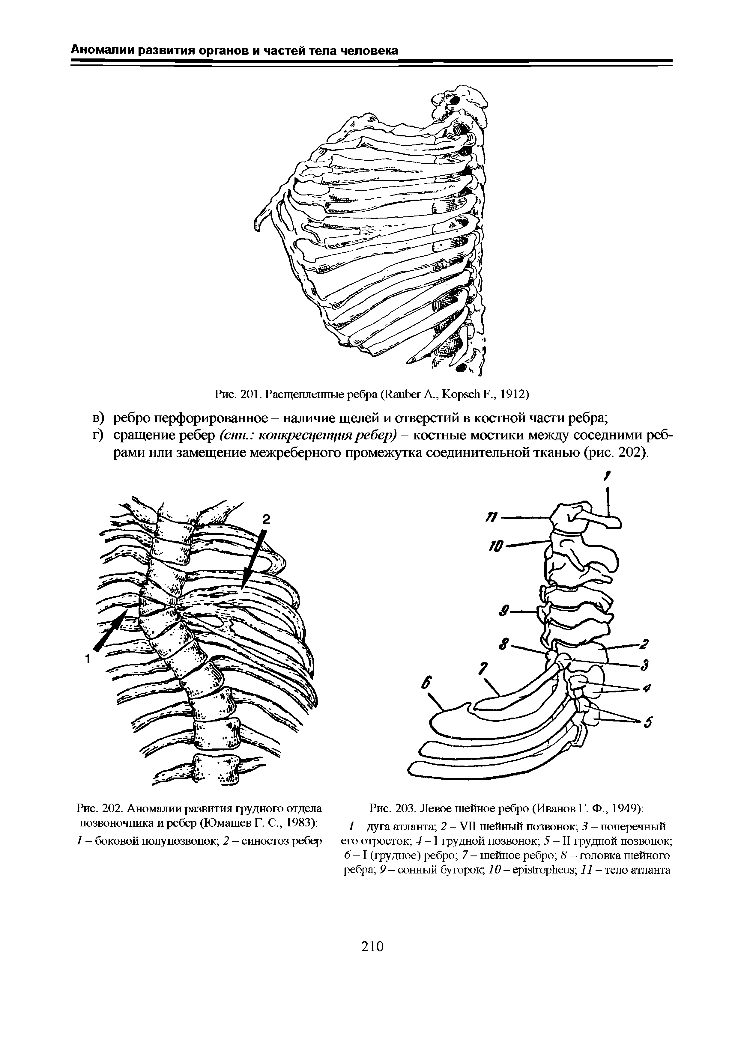 Рис. 202. Аномалии развития грудного отдела позвоночника и ребер (Юмашев Г. С., 1983) ...