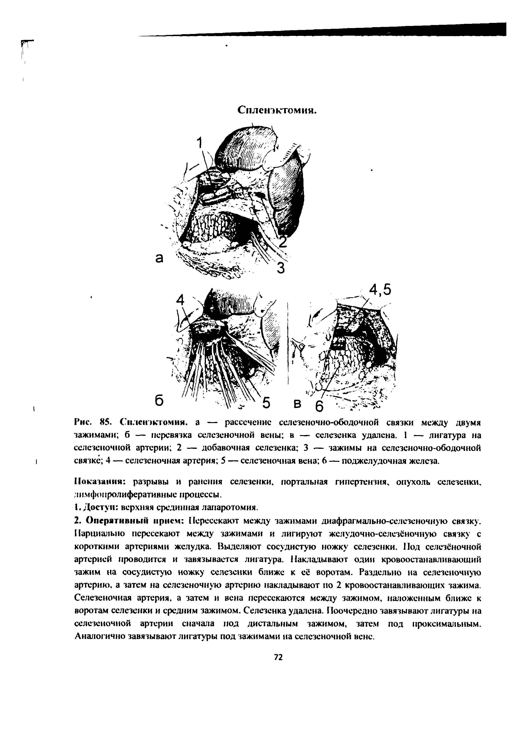 Рис. 85. Спленэктомия. а — рассечение селезеночно-ободочной связки между двумя зажимами б — перевязка селезеночной вены в — селезенка удалена. 1 — лигатура на селезеночной артерии 2 — добавочная селезенка 3 — зажимы на селезеночно-ободочной I связке 4 — селезеночная артерия 5 — селезеночная вена 6 — поджелудочная железа.