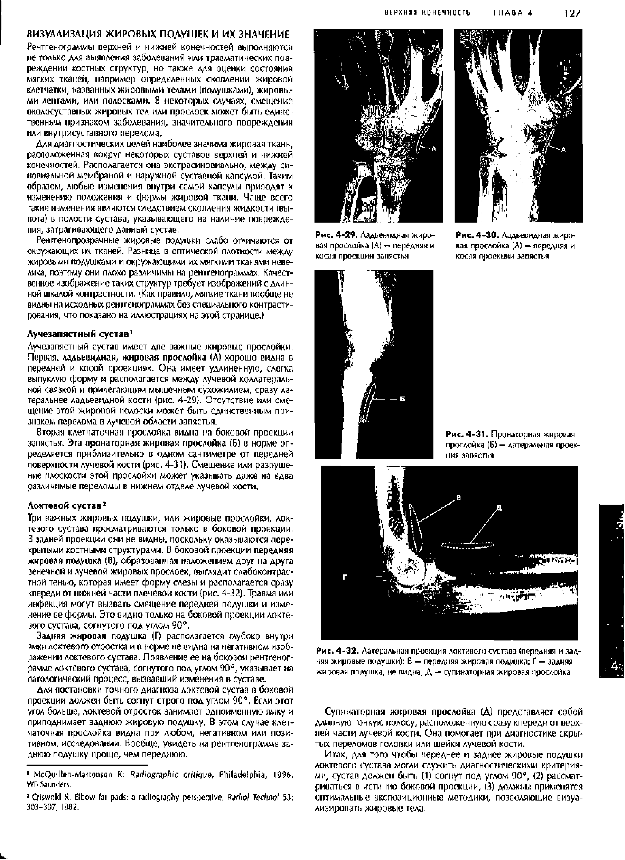 Рис. 4-32. Латеральная проекция локтевого сустава (передняя и задняя жировые подушки) В — передняя жировая подушка Г — задняя жировая полушка, не видна Д - супинаторная жировая прослойка...