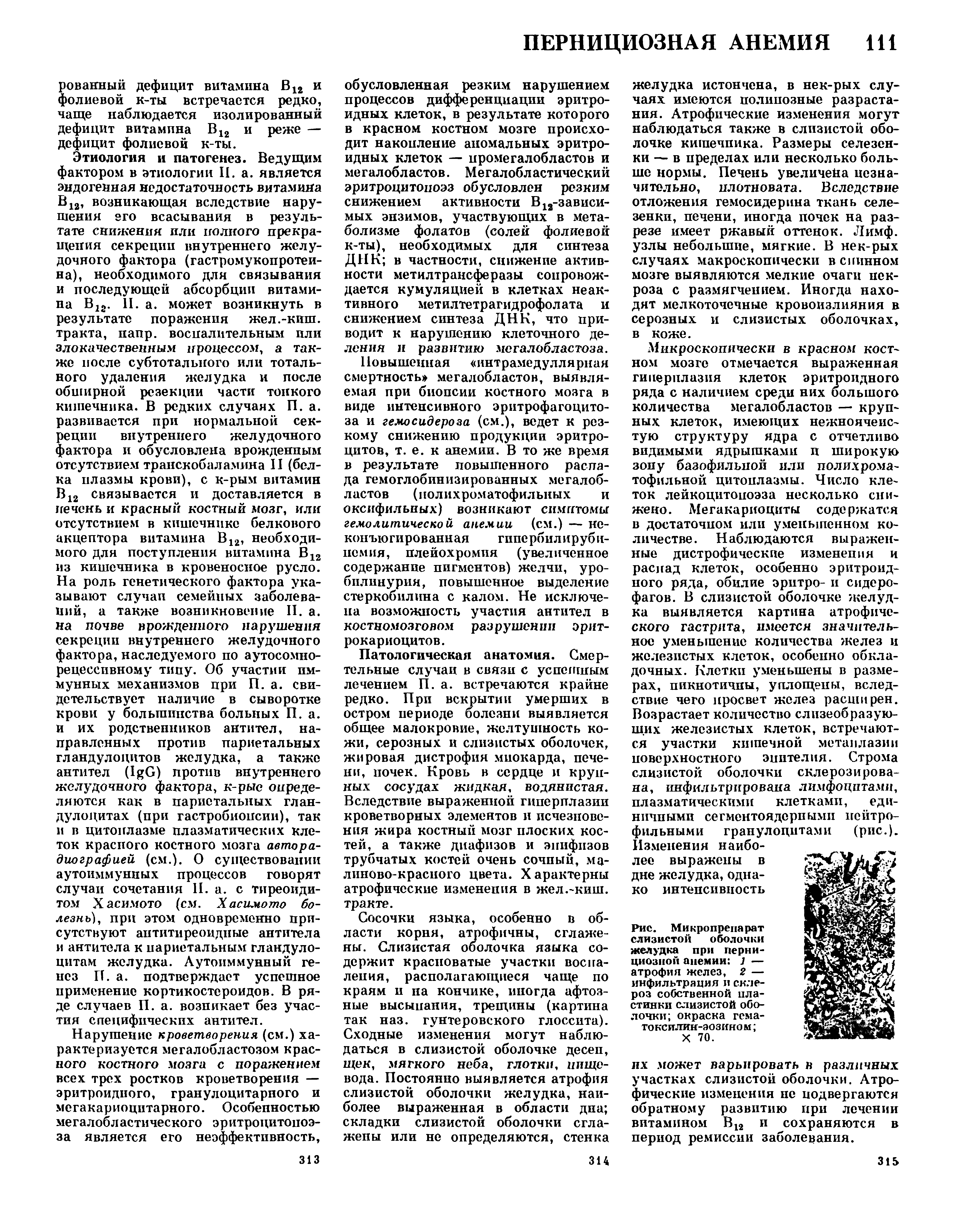 Рис. Микропрепарат слизистой оболочки желудка при пернициозной анемии ] — атрофия желез, 2 — инфильтрация и склероз собственной пластинки слизистой оболочки окраска гема-токсилин-эозином ...