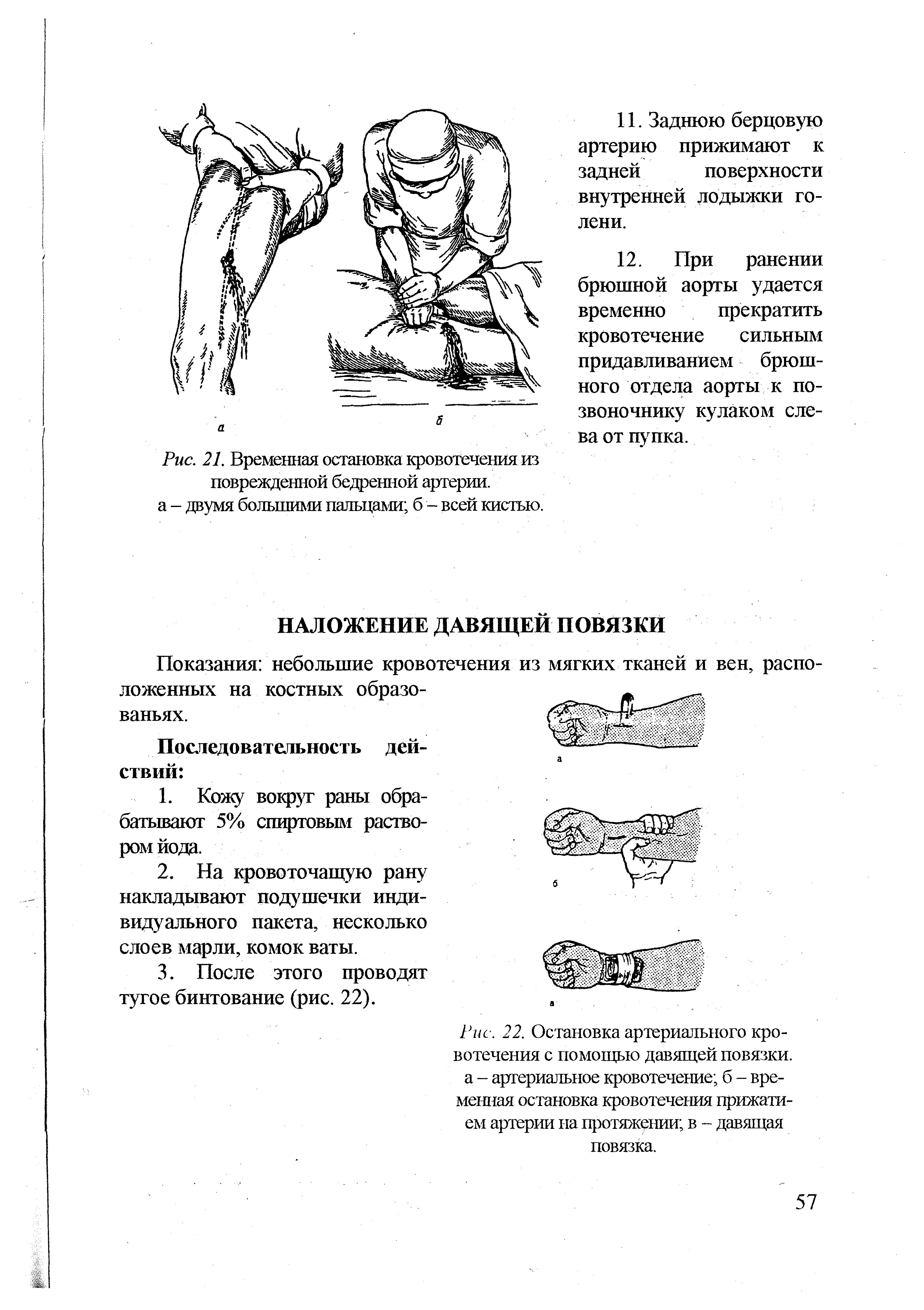 Рис. 22. Остановка артериального кровотечения с помощью давящей повязки, а - артериальное кровотечение б - временная остановка кровотечения прижатием артерии на протяжении в - давящая повязка.