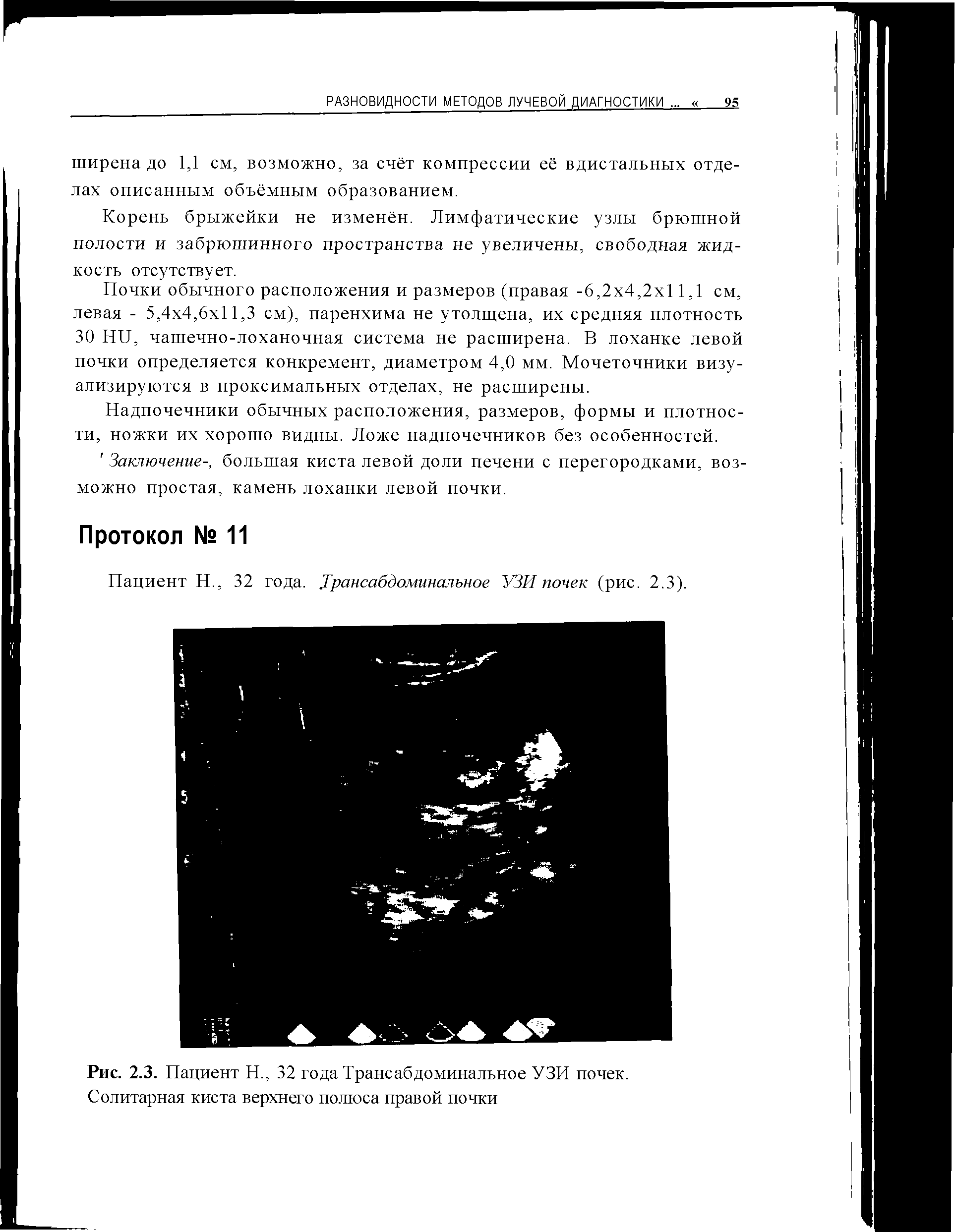 Рис. 2.3. Пациент Н., 32 года Трансабдоминальное УЗИ почек. Солитарная киста верхнего полюса правой почки...