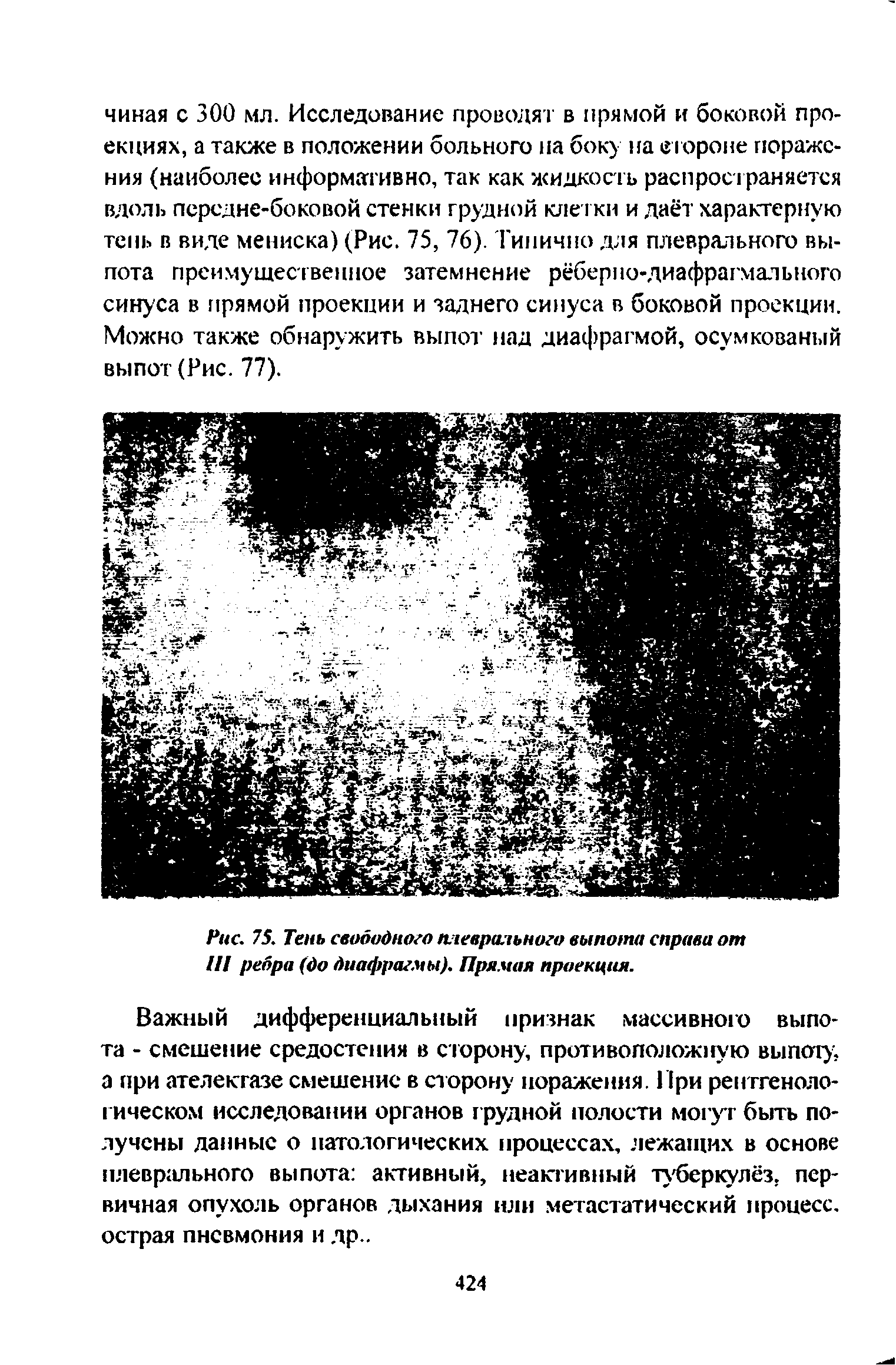 Рис. 75. Тень свободного плеврального выпота справа от III ребра (до диафрагмы). Прямая проекция.