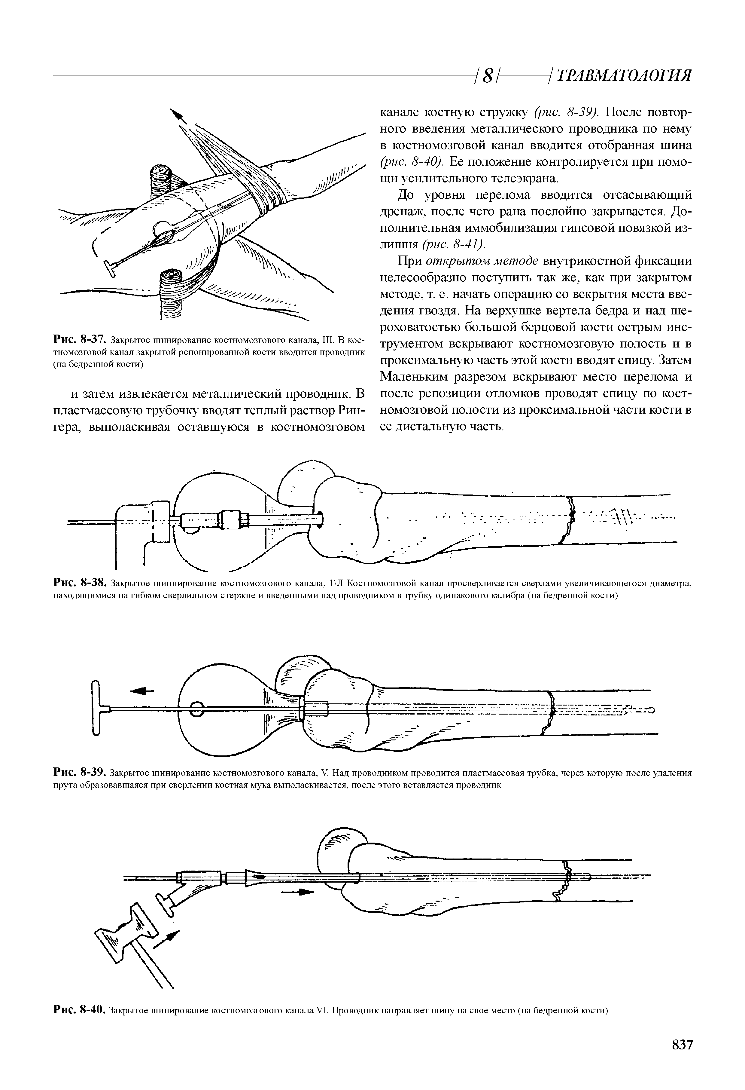 Рис. 8-37. Закрытое шинирование костномозгового канала, III. В костномозговой канал закрытой репонированной кости вводится проводник (на бедренной кости)...