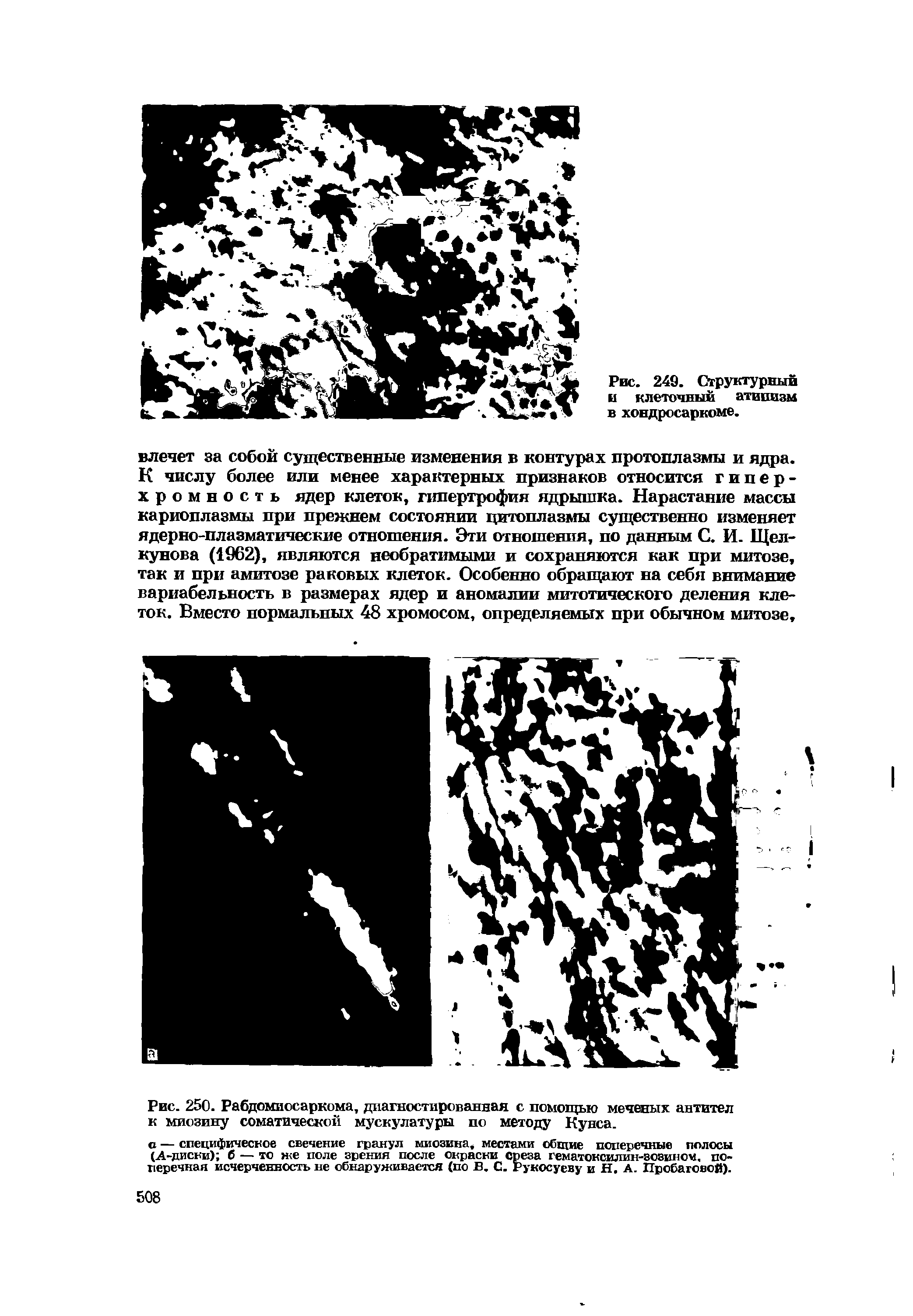 Рис. 250. Рабдомиосаркома, диагностированная с помощью меченых антител к миозину соматической мускулатуры по методу Кунса.