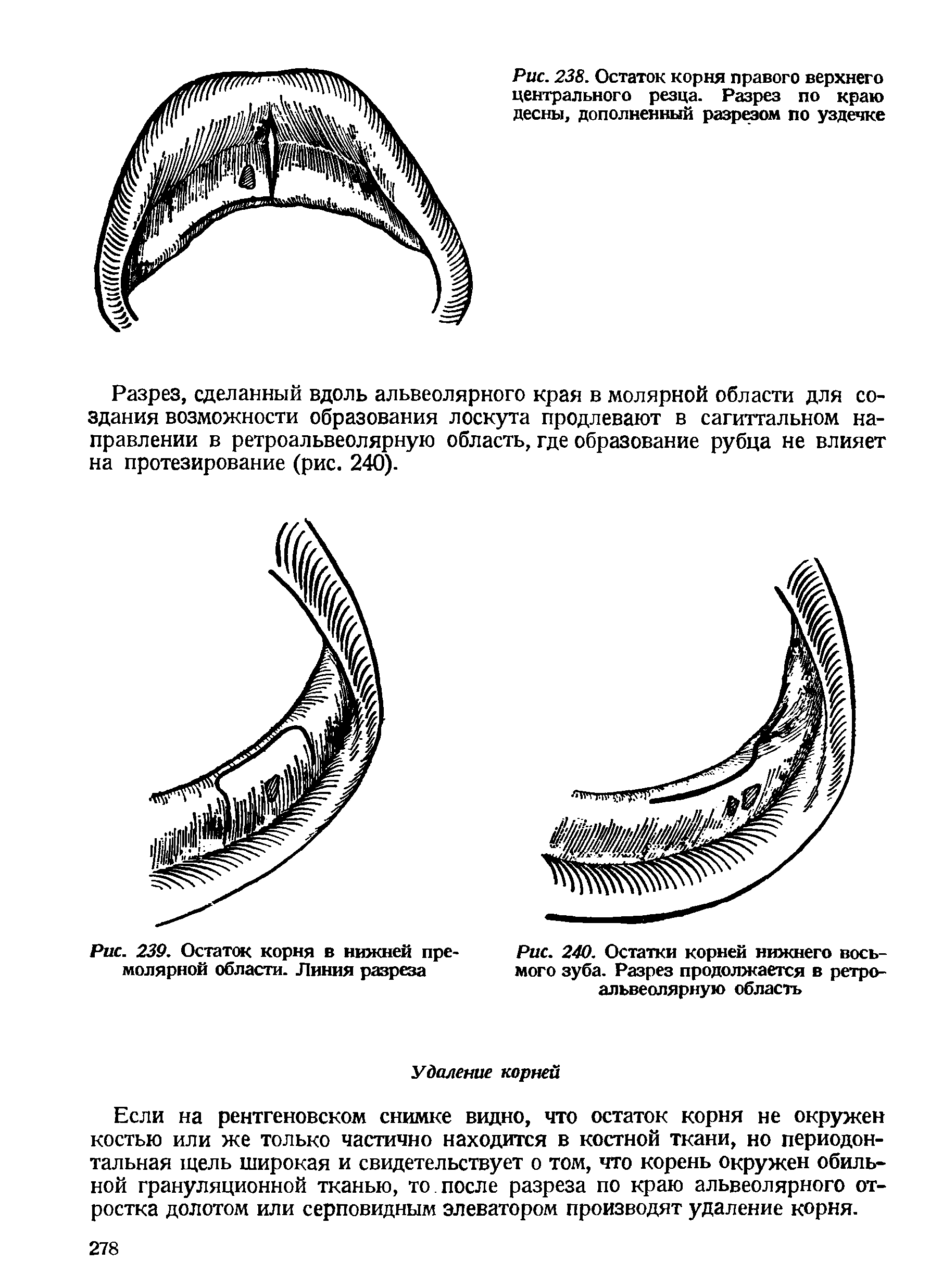 Рис. 239. Остаток корня в нижней пре-молярной области. Линия разреза...