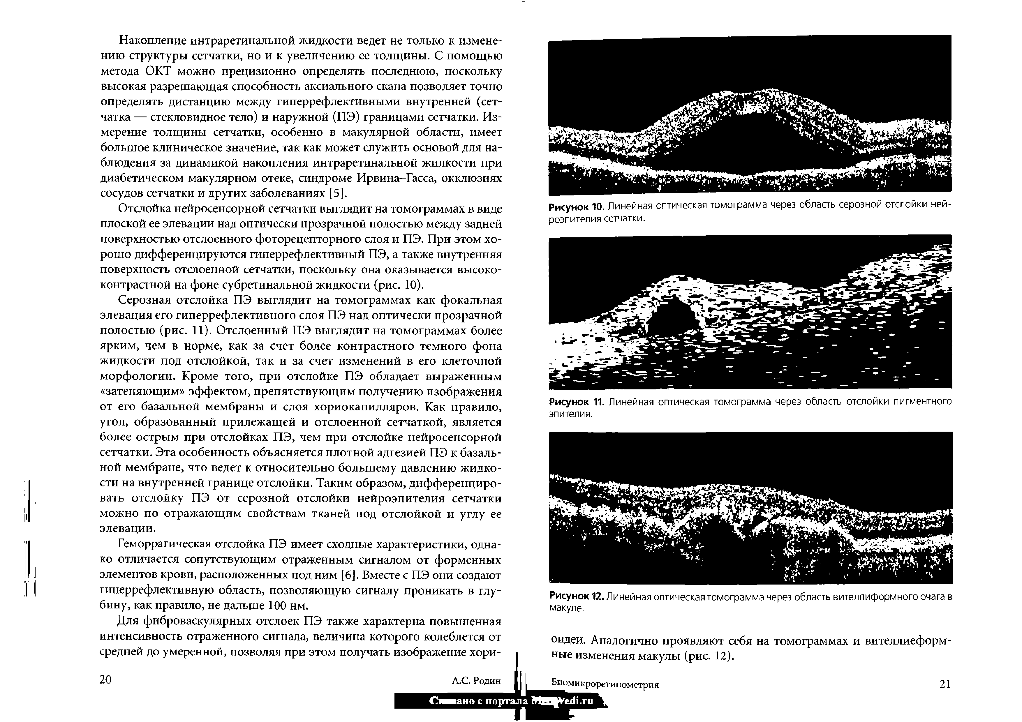 Рисунок 10. Линейная оптическая томограмма через область серозной отслойки нейроэпителия сетчатки.