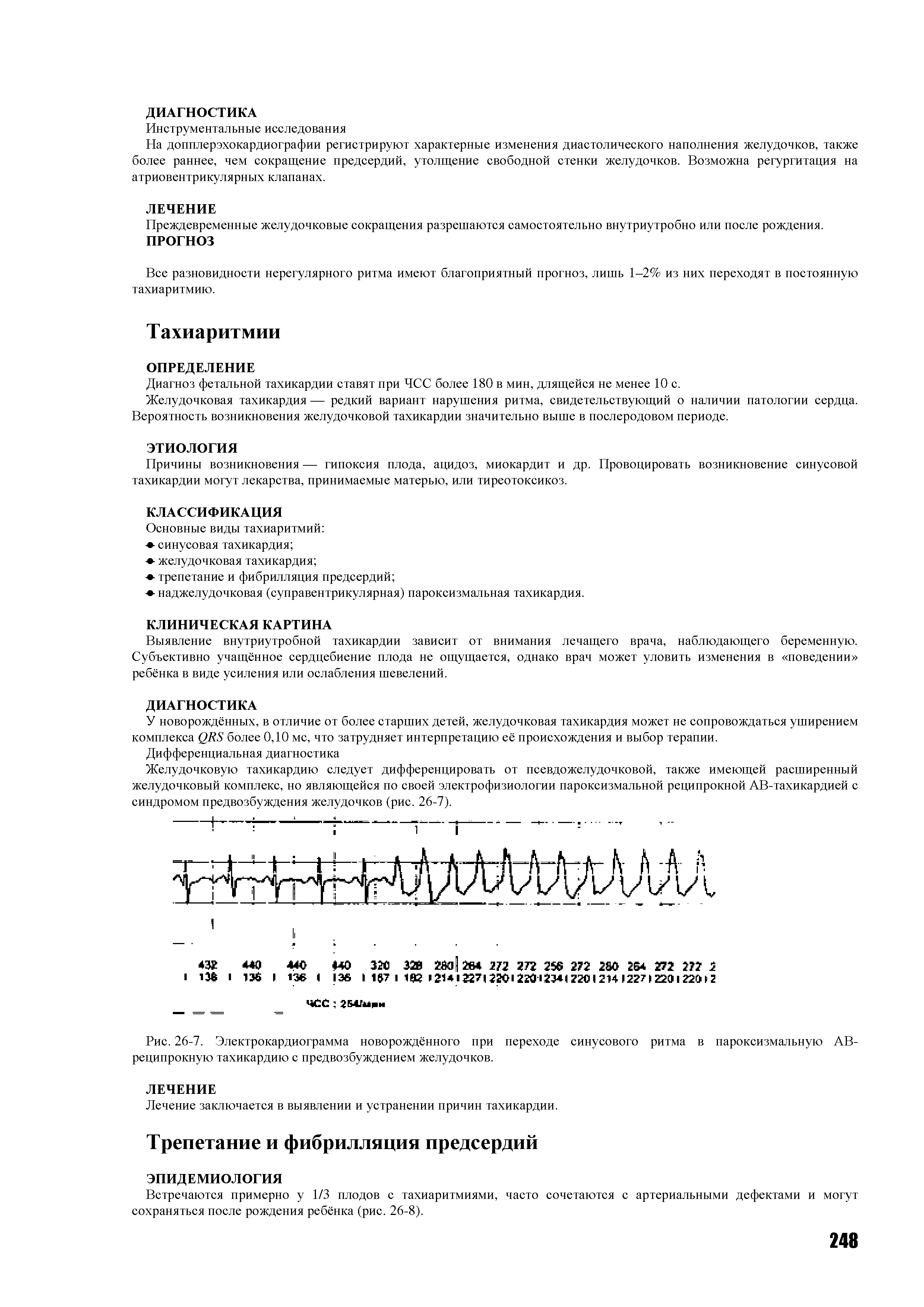 Рис. 26-7. Электрокардиограмма новорождённого при переходе синусового ритма в пароксизмальную АВ-реципрокную тахикардию с предвозбуждением желудочков.