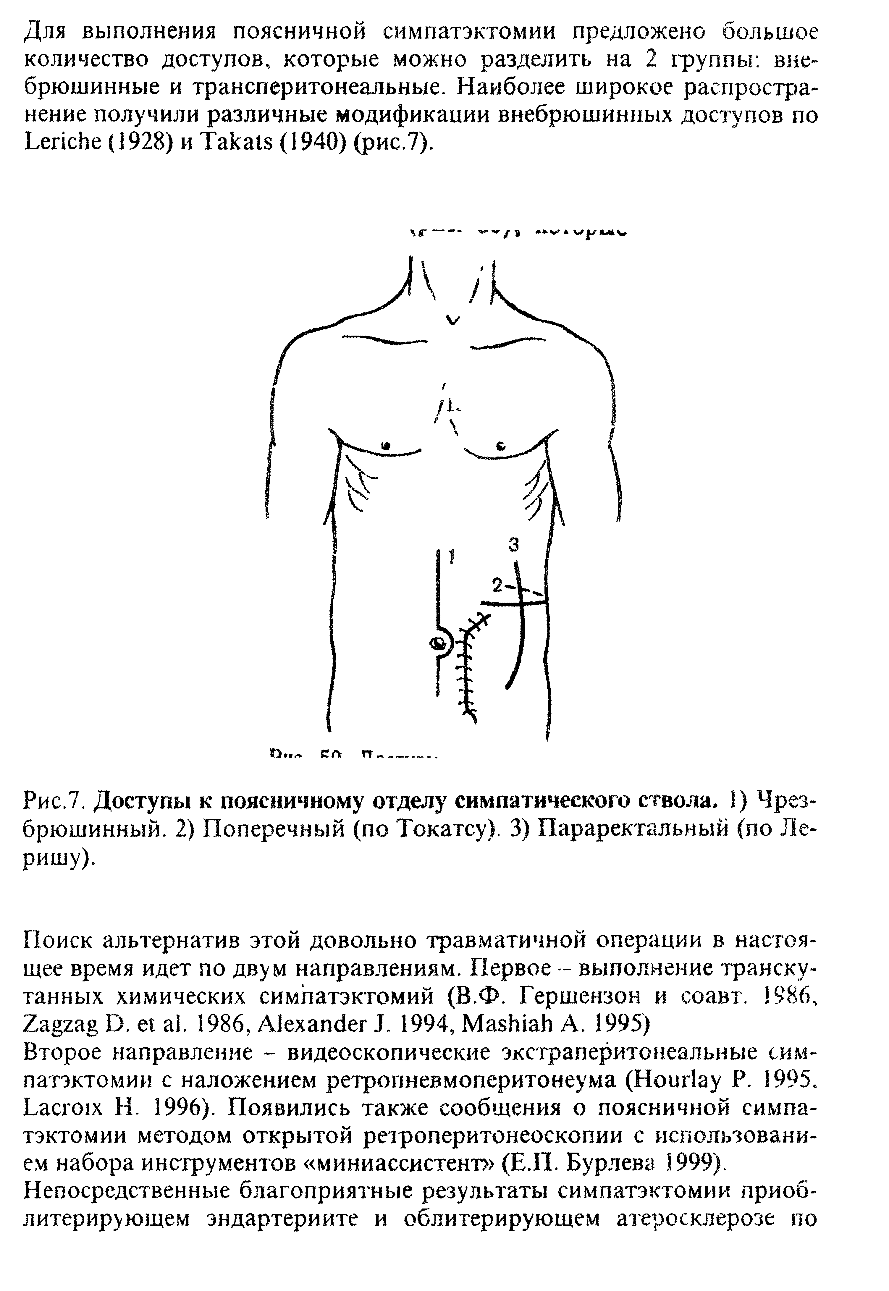 Рис.7. Доступы к поясничному отделу симпатического ствола, 1) Чрез-брюшинный. 2) Поперечный (по Токатсу). 3) Параректальный (по Ле-ришу).