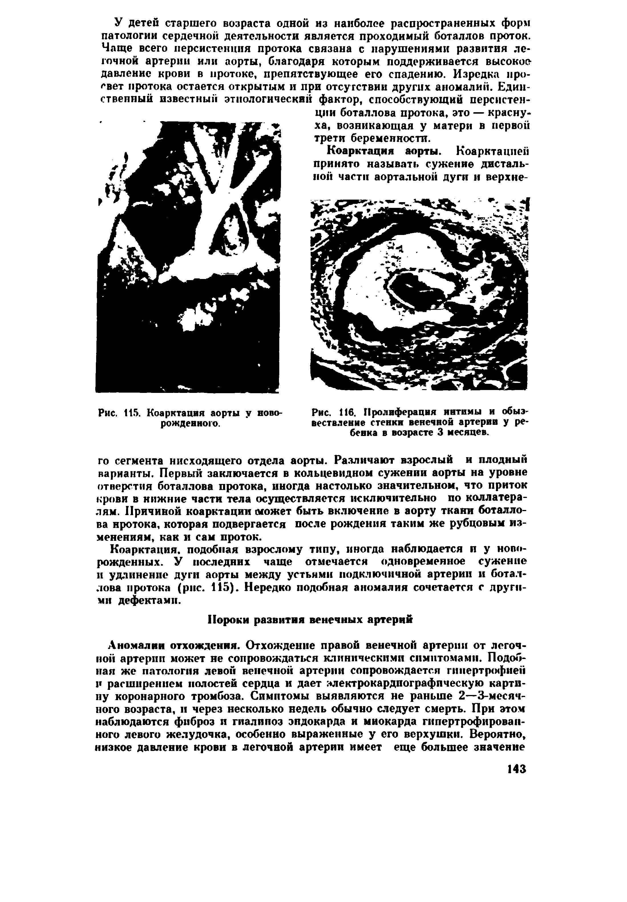 Рис. 116. Пролиферация интимы и обызвествление стенки веиечной артерии у ребенка в возрасте 3 месяцев.