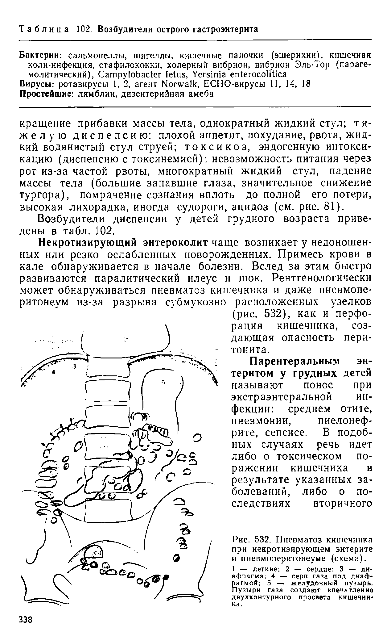 Рис. 532. Пневматоз кишечника при некротизирующем энтерите и пневмоперитонеуме (схема).