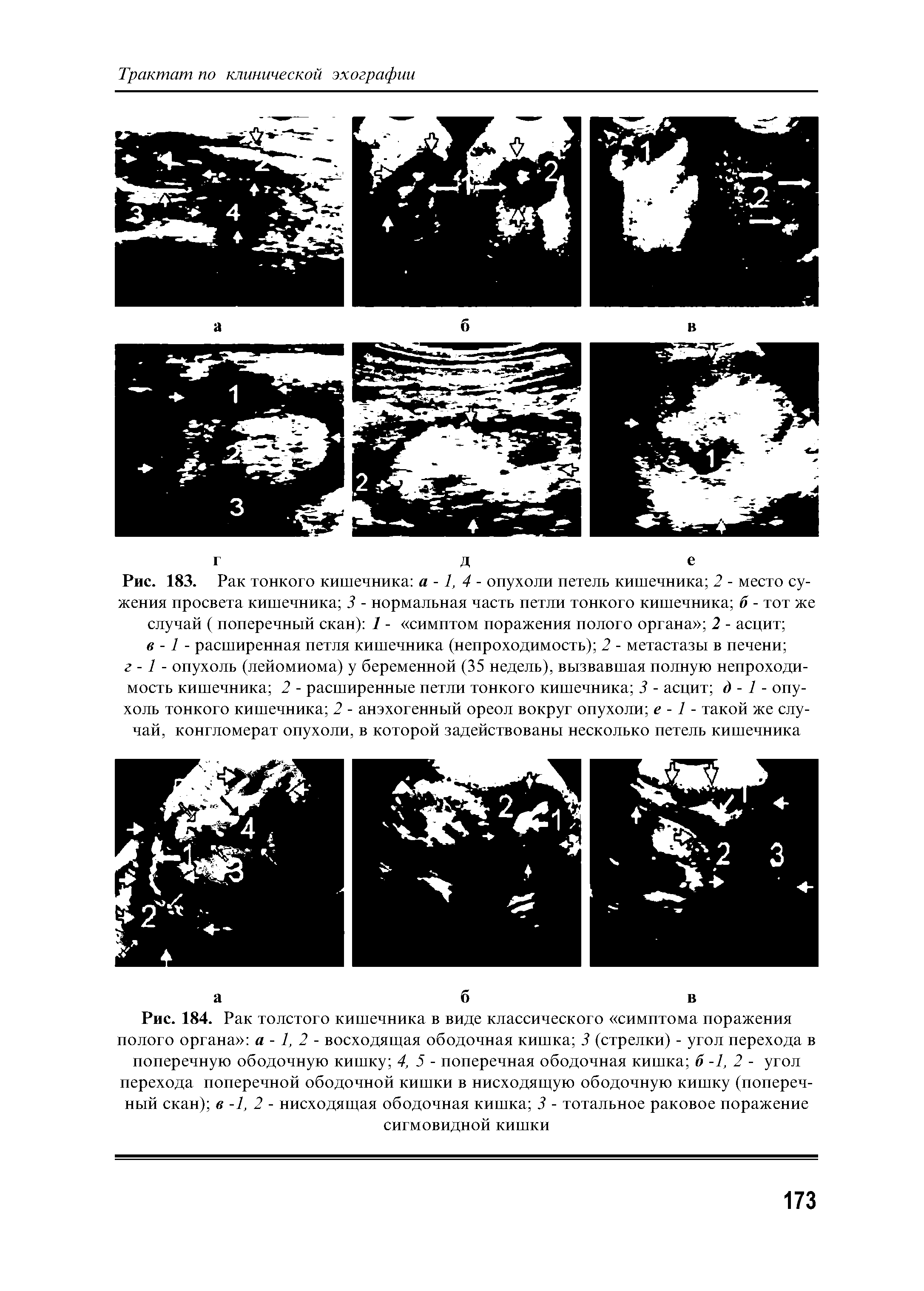 Рис. 183. Рак тонкого кишечника а -1, 4 - опухоли петель кишечника 2 - место сужения просвета кишечника 3 - нормальная часть петли тонкого кишечника б - тот же случай ( поперечный скан) 1 - симптом поражения полого органа 2 - асцит в -1 - расширенная петля кишечника (непроходимость) 2 - метастазы в печени ...